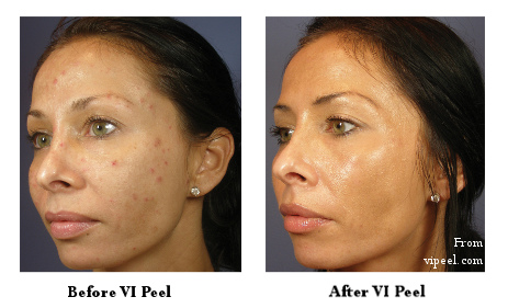 VIPeel2