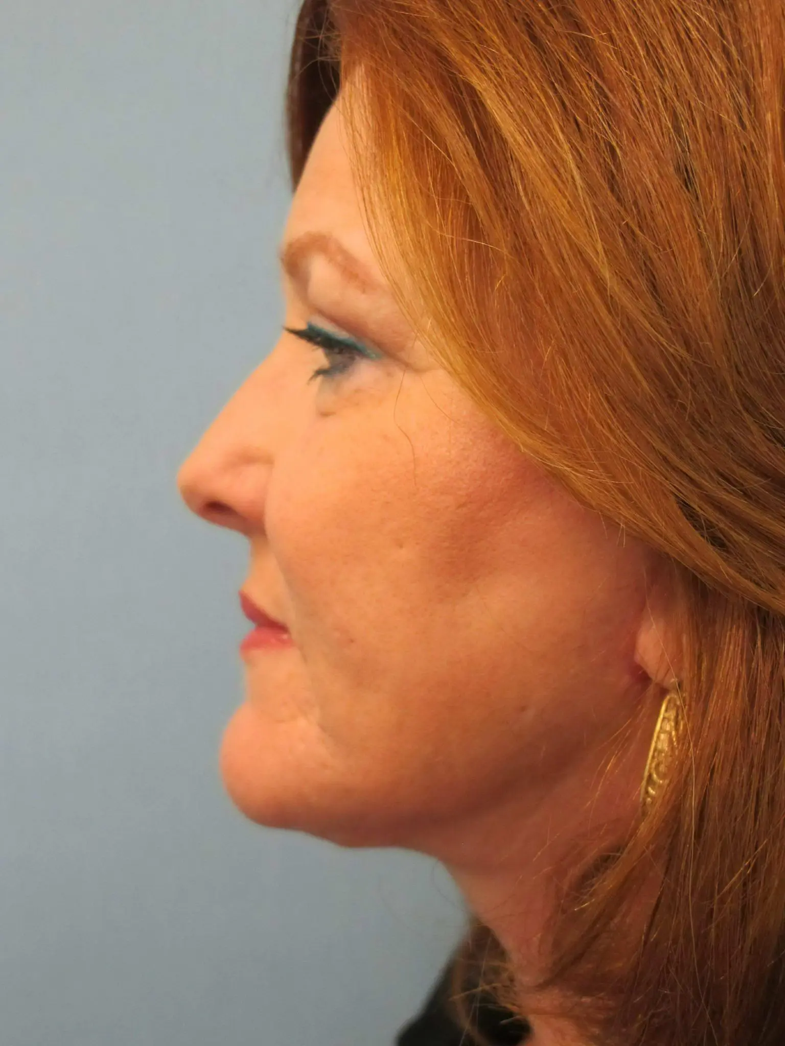 Eyelid Surgery Patient Photo - Case 116 - after view-2