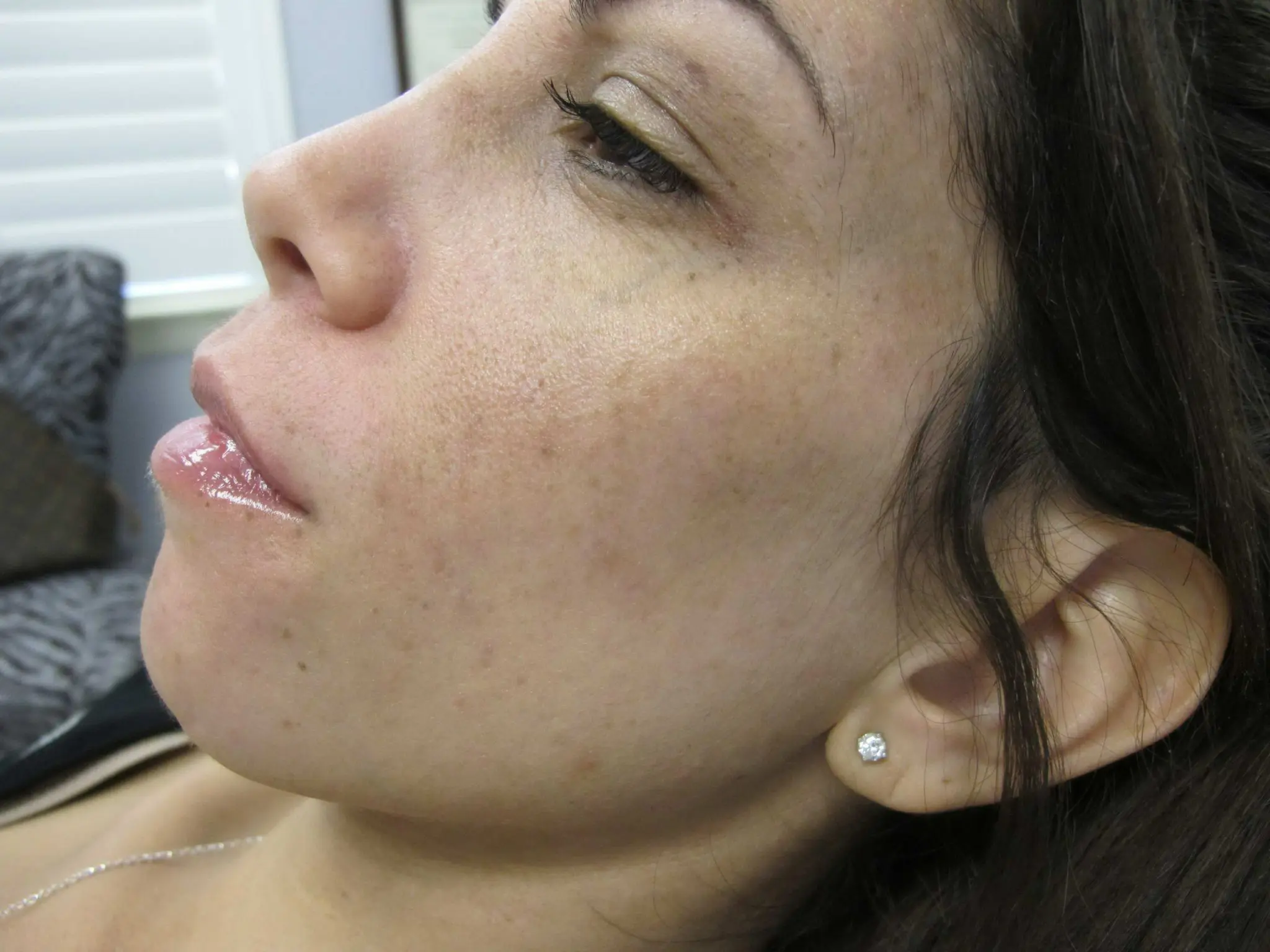 Laser Treatments Patient Photo - Case 130 - before view-1