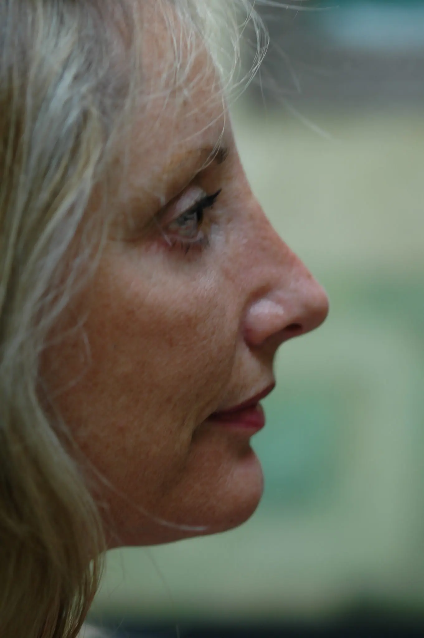 Eyelid Surgery Patient Photo - Case 104 - after view-1