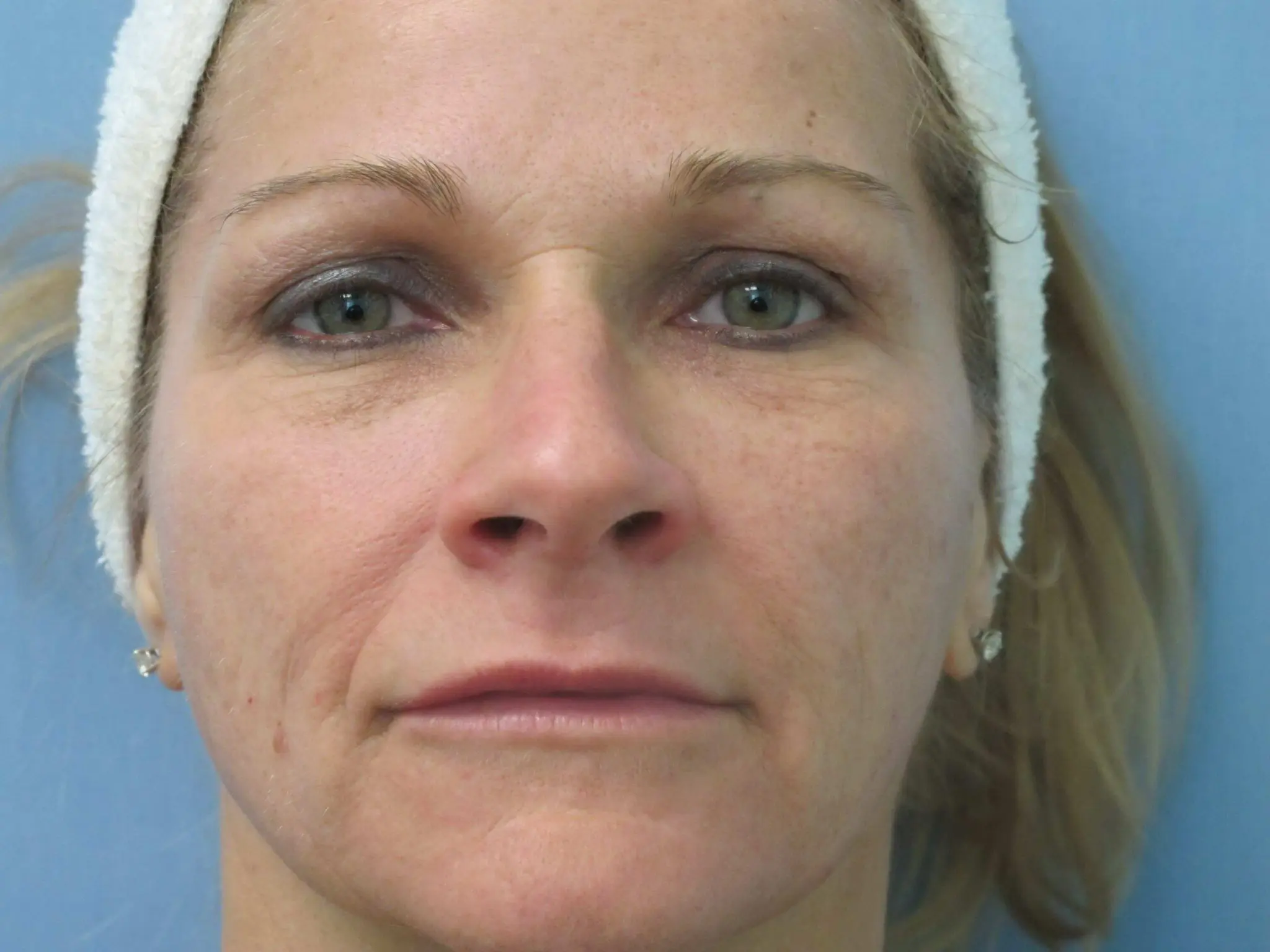 Laser Treatments Patient Photo - Case 123 - after view