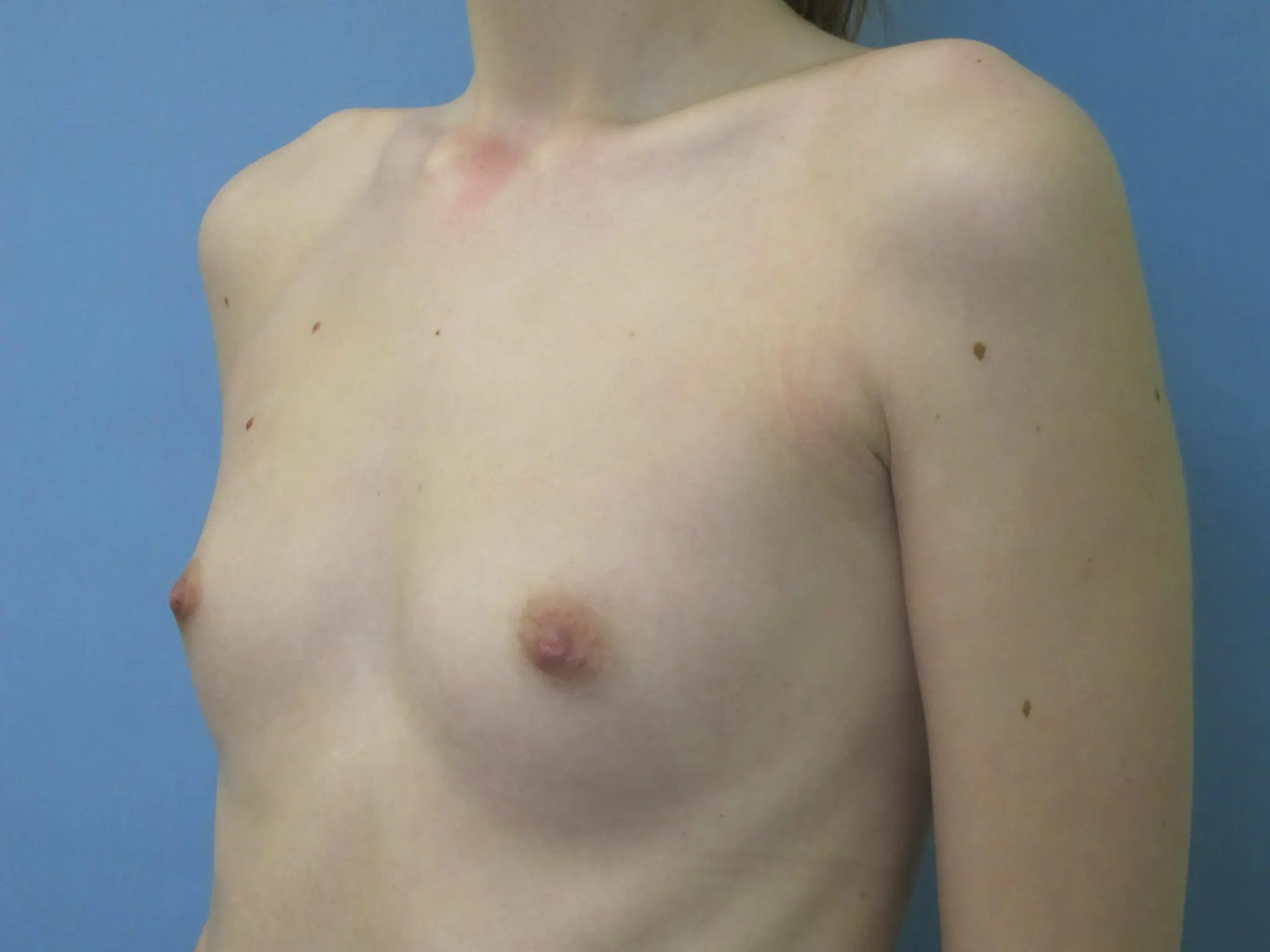 Breast Augmentation Patient Photo - Case 131 - before view-1