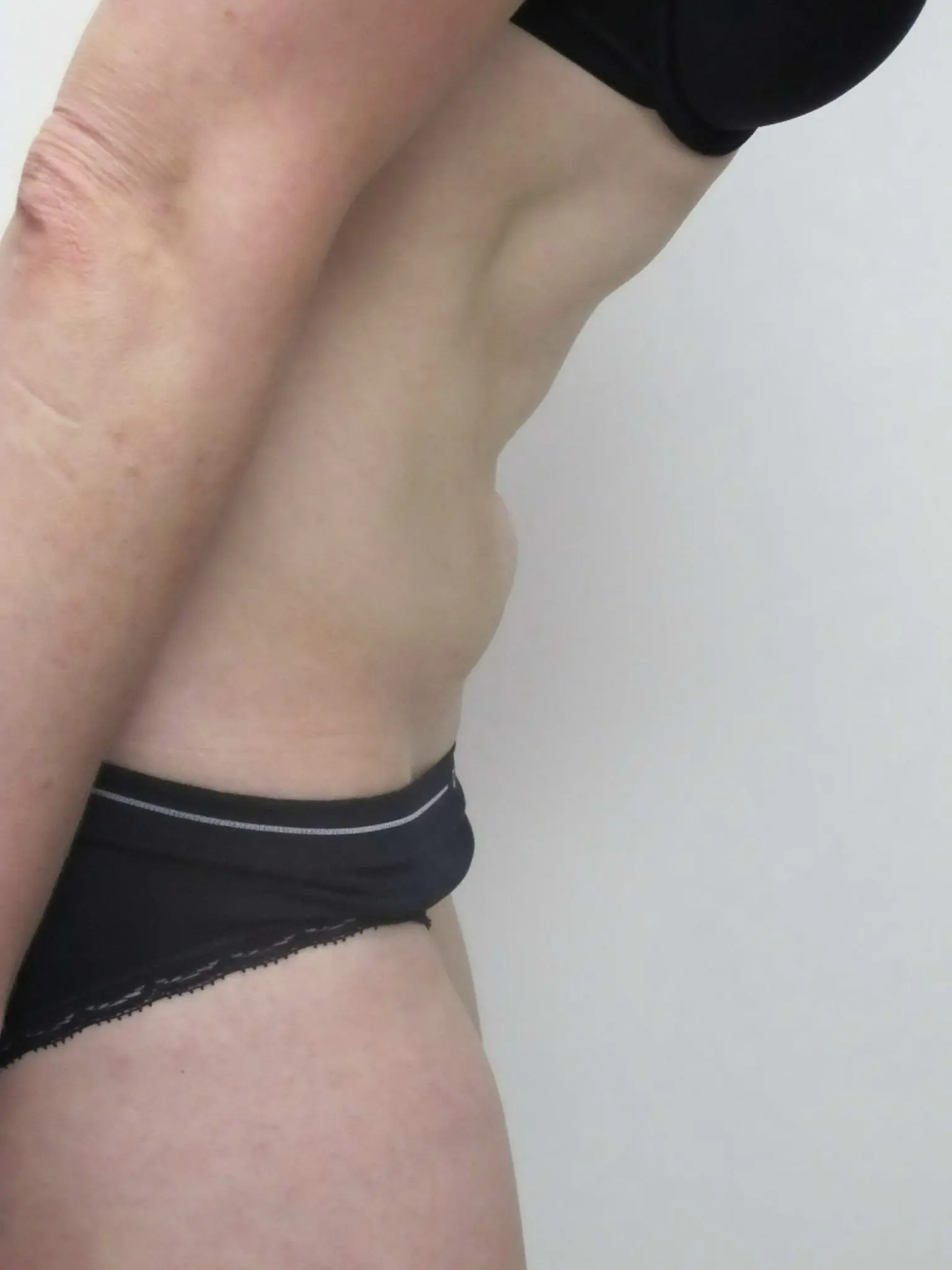 Liposuction Patient Photo - Case 146 - before view-1
