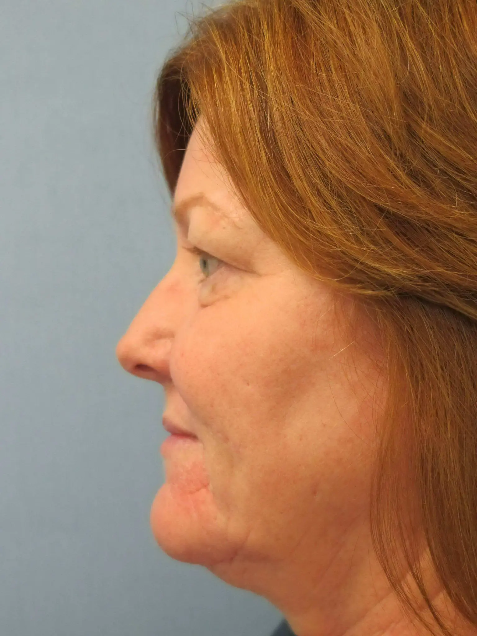 Eyelid Surgery Patient Photo - Case 116-5 - before view-1