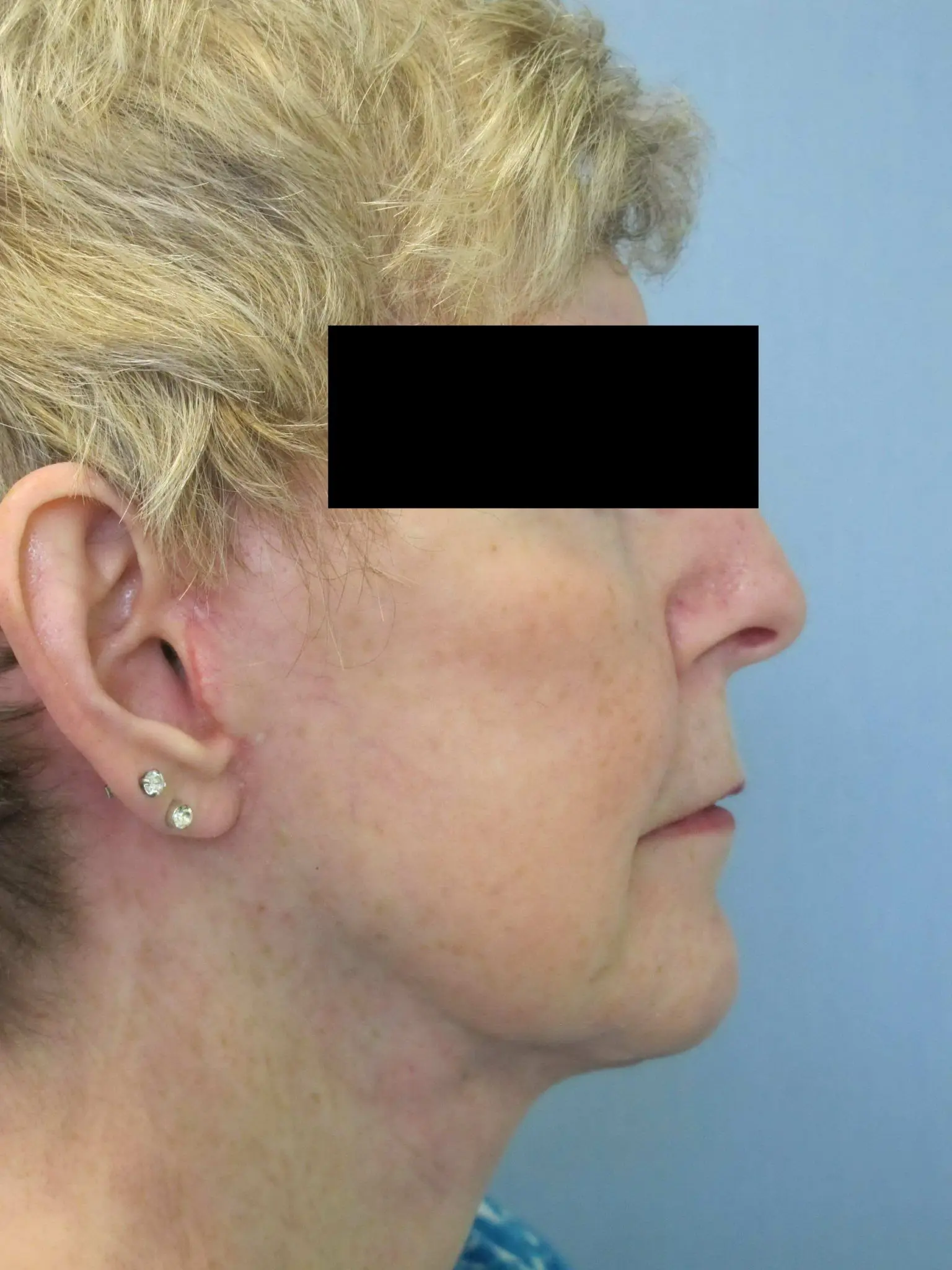 Facelift Patient Photo - Case 56 - after view-1