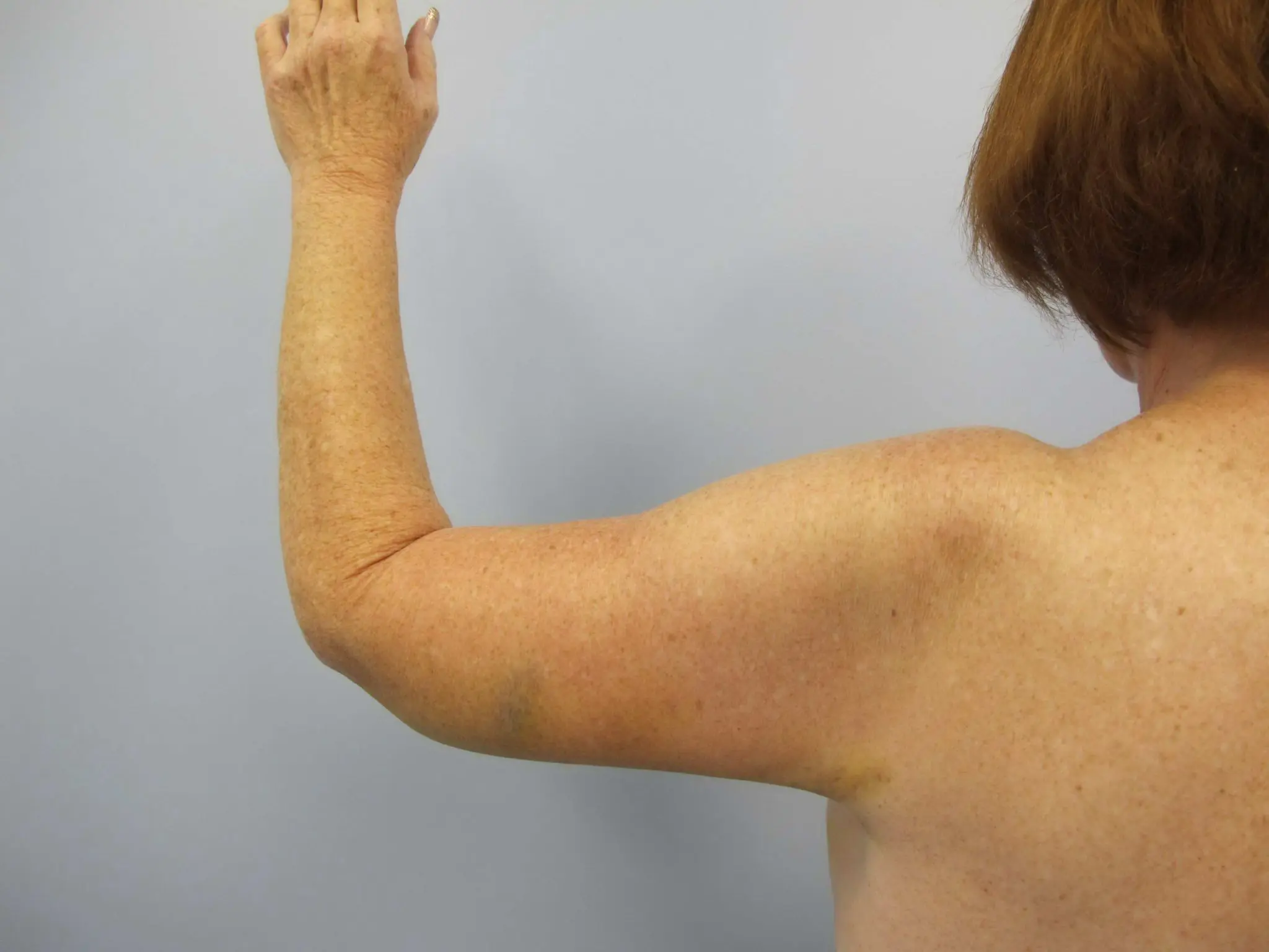 Liposuction Patient Photo - Case 77 - after view