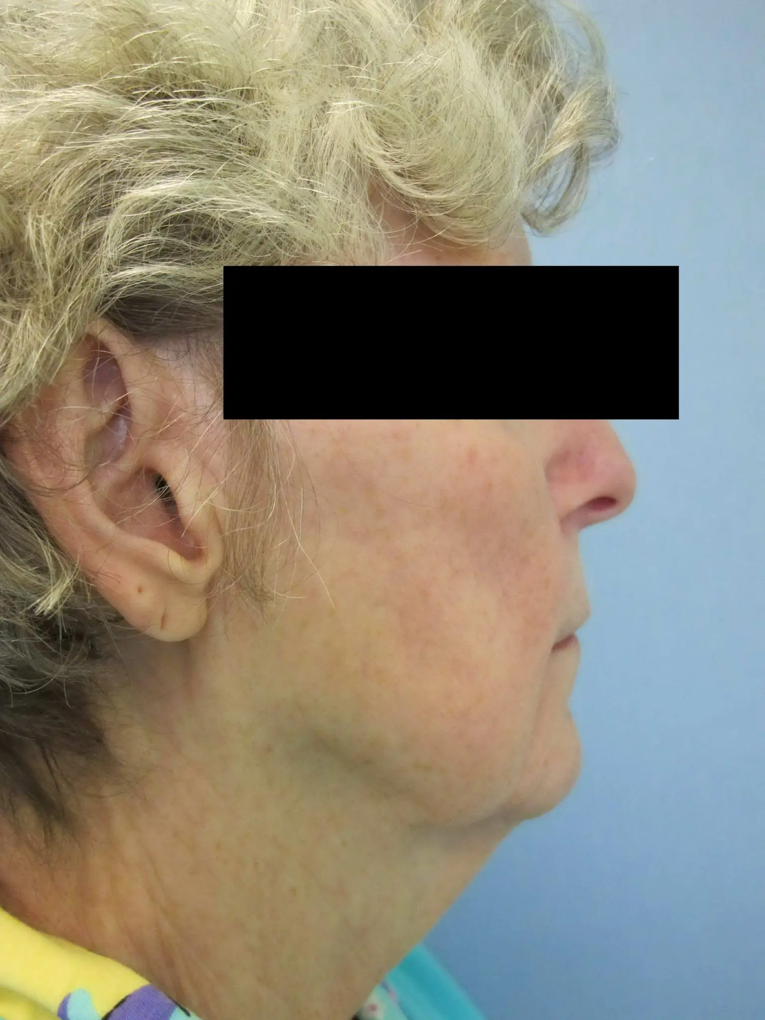 Facelift Patient Photo - Case 56 - before view-1