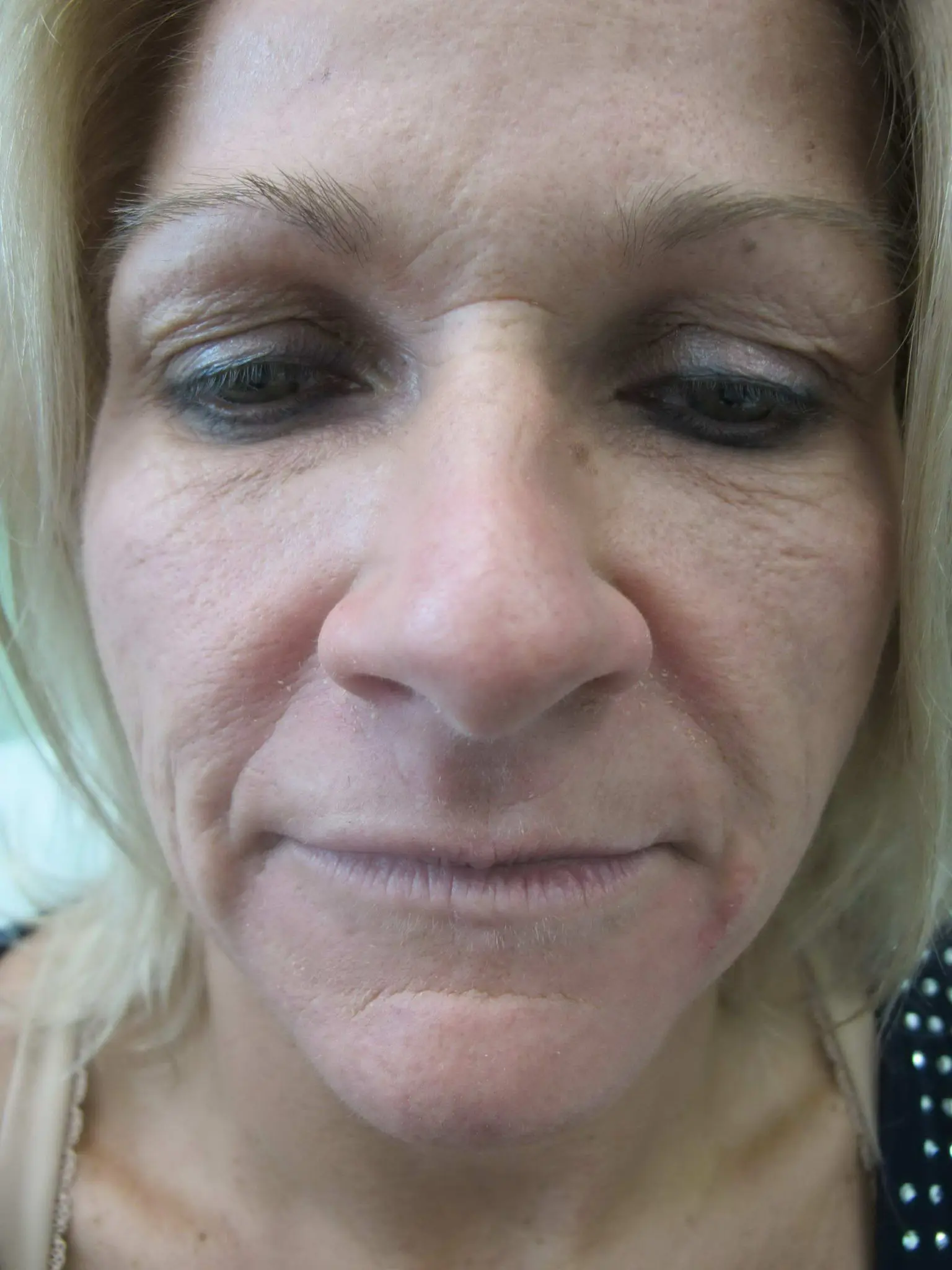 Laser Treatments Patient Photo - Case 123 - before view-