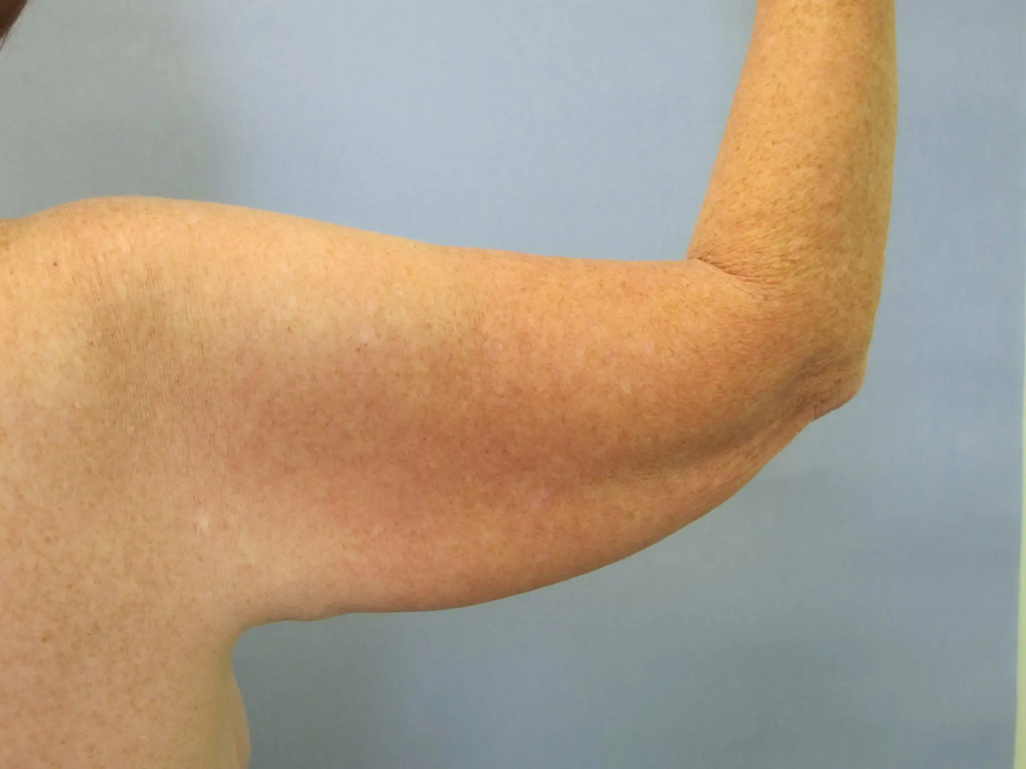 Liposuction Patient Photo - Case 77 - before view-1