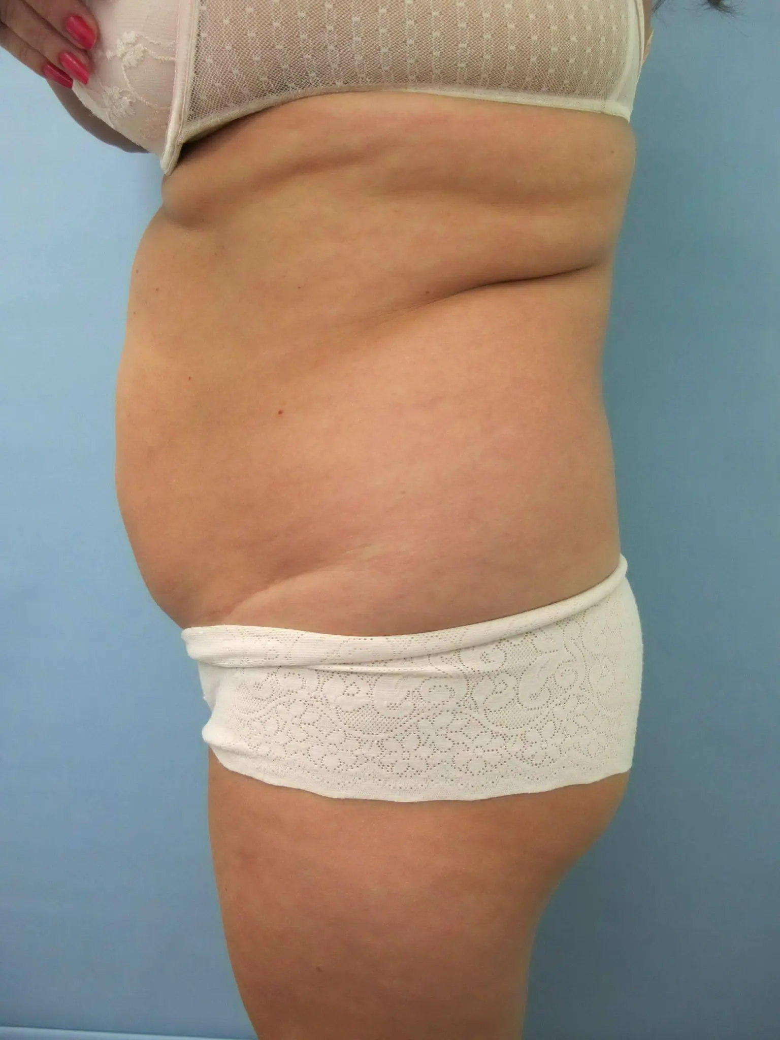 Liposuction Patient Photo - Case 80 - before view-