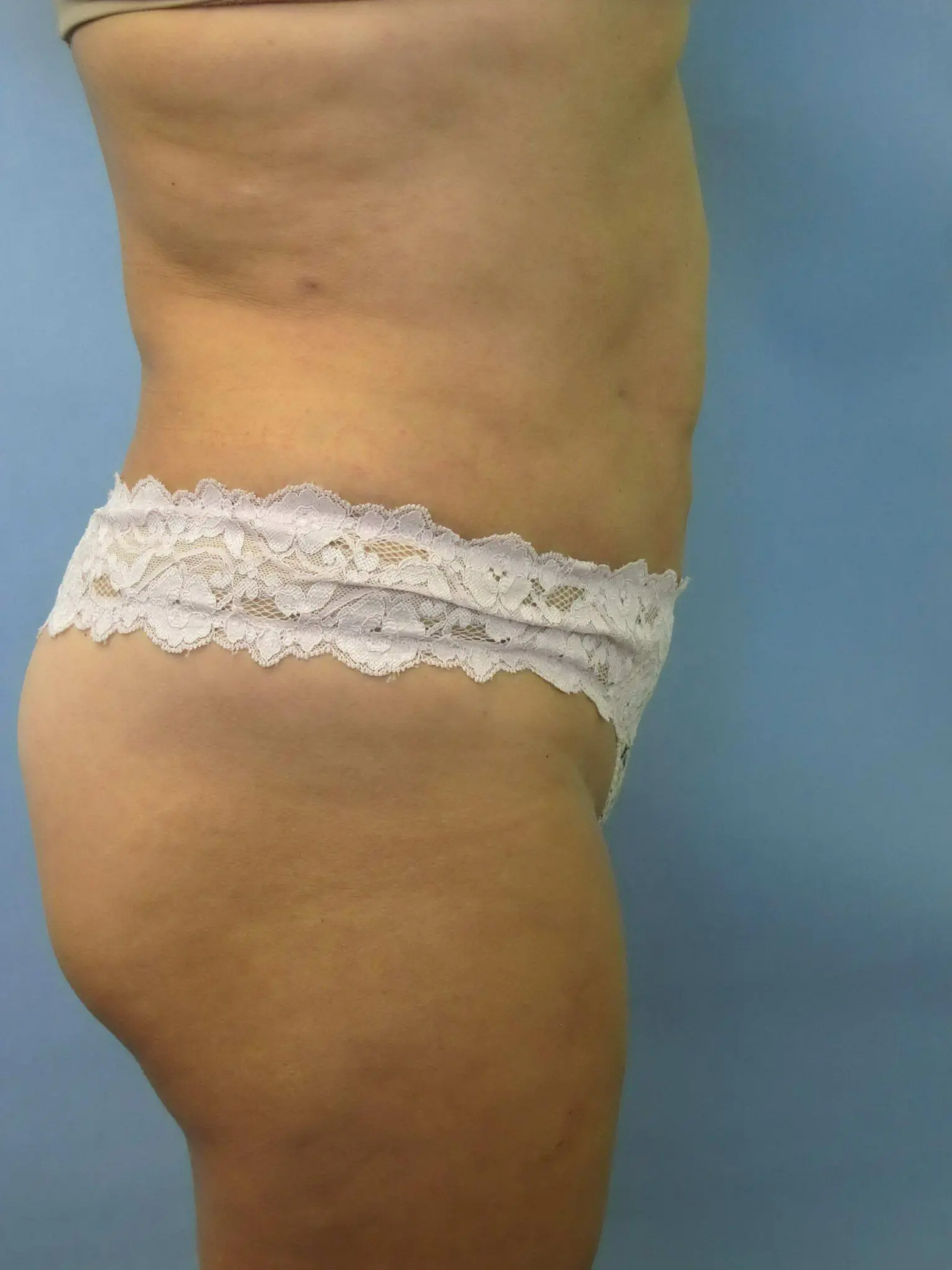 Liposuction Patient Photo - Case 80 - after view-1