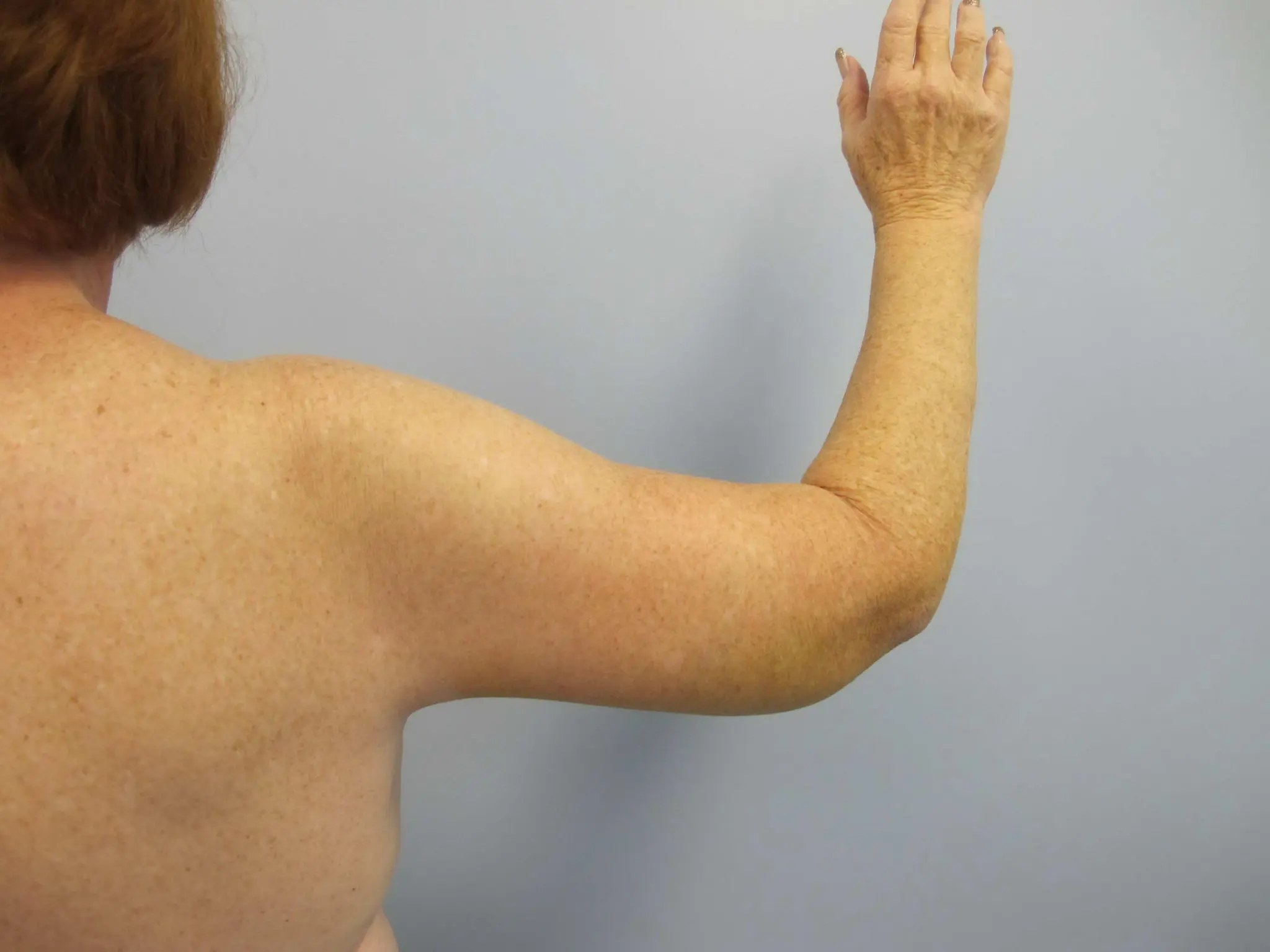 Liposuction Patient Photo - Case 77 - after view-1