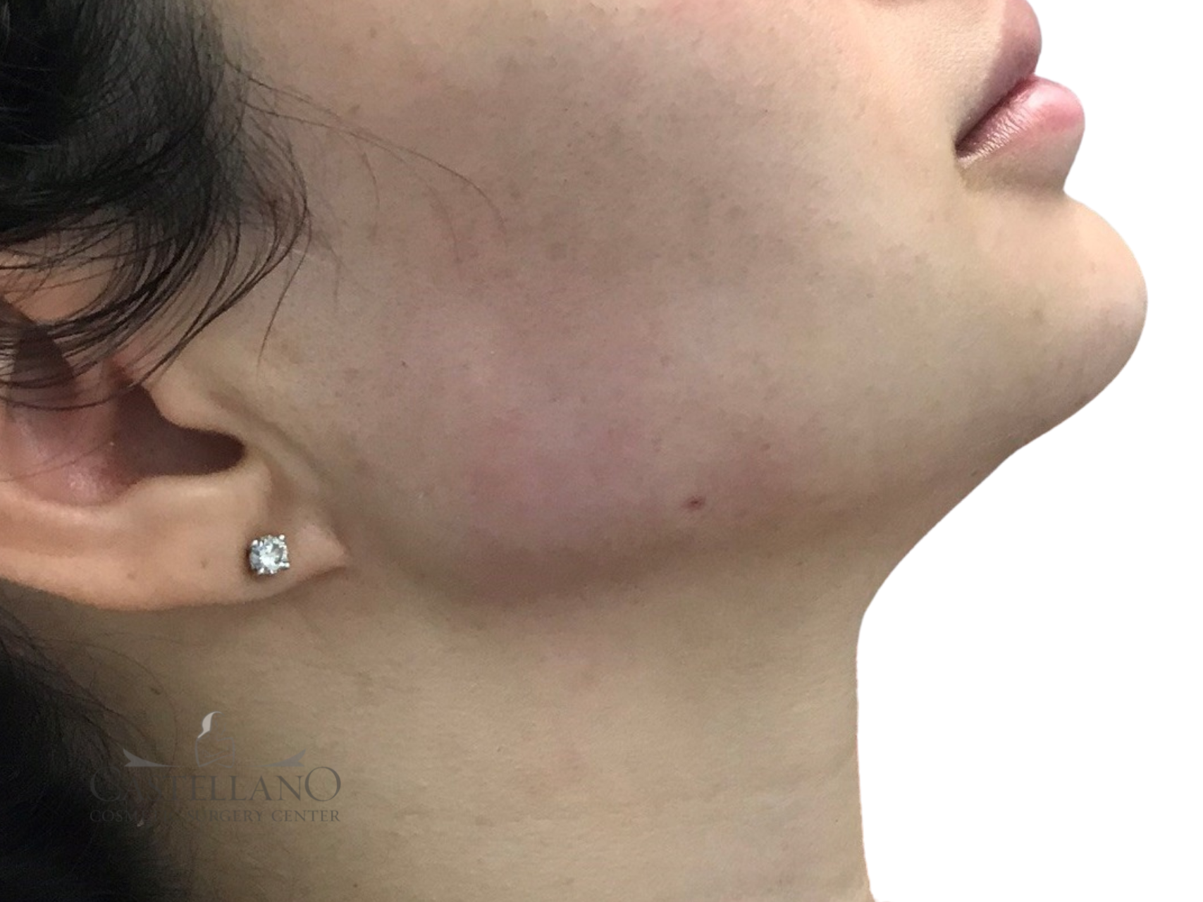 Injectable Fillers Patient Photo - Case 8257 - after view