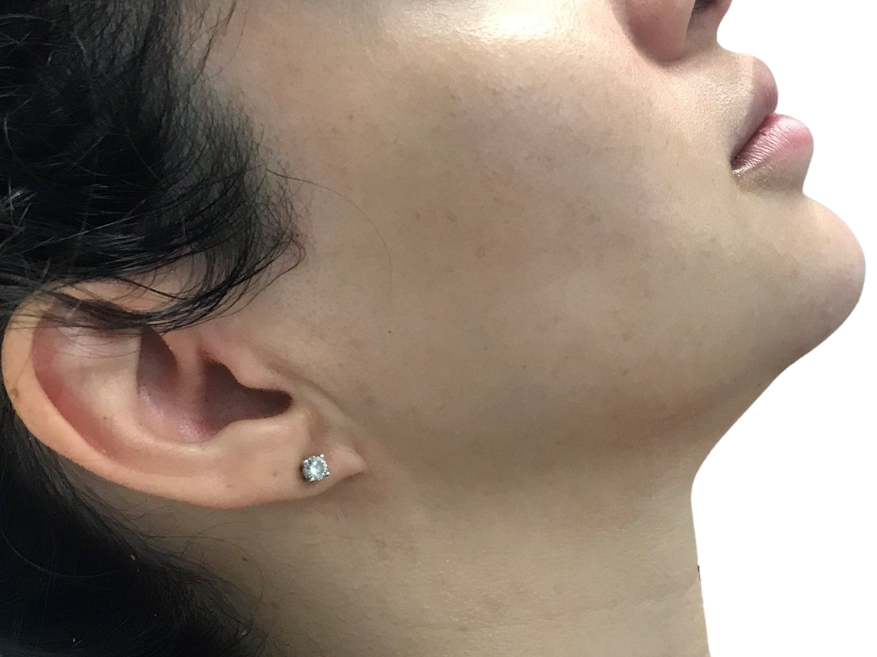 Injectable Fillers Patient Photo - Case 8257 - before view-