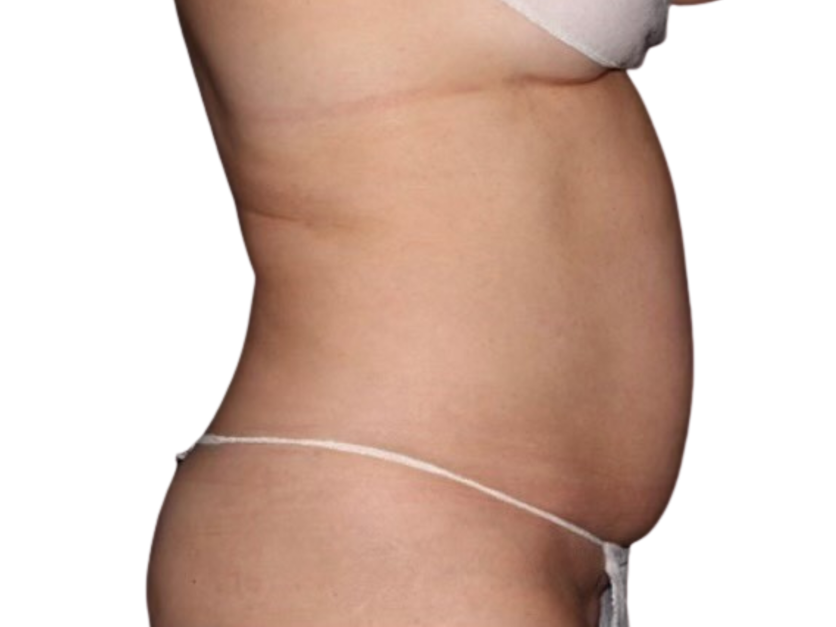 Coolsculpting® Patient Photo - Case 18369 - before view-
