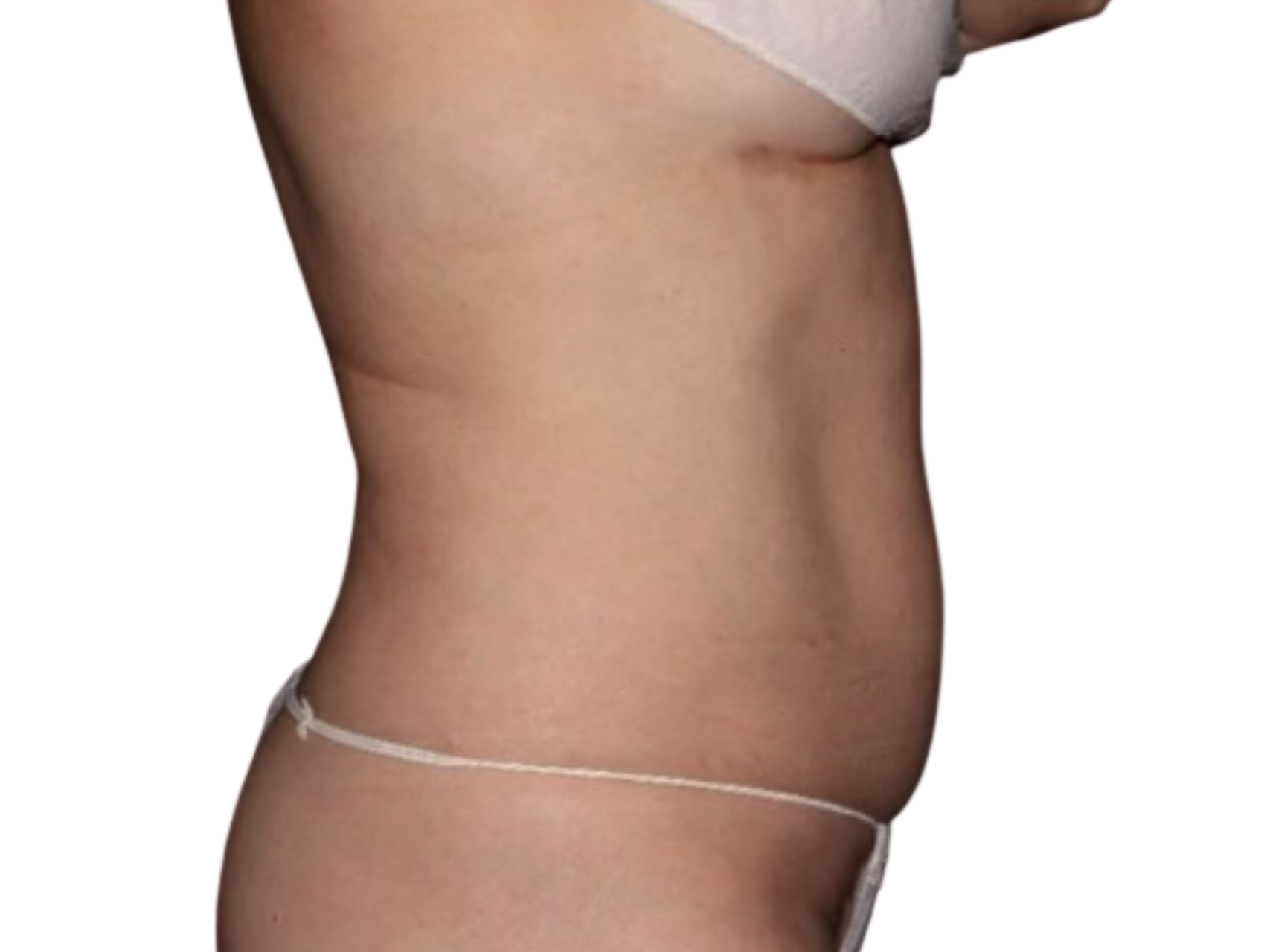Coolsculpting® Patient Photo - Case 18369 - after view