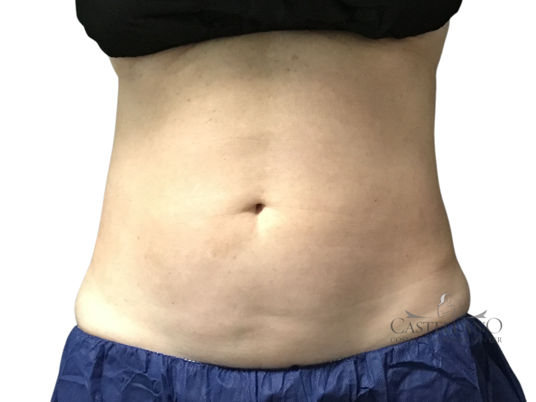 Coolsculpting® Patient Photo - Case 18571 - after view