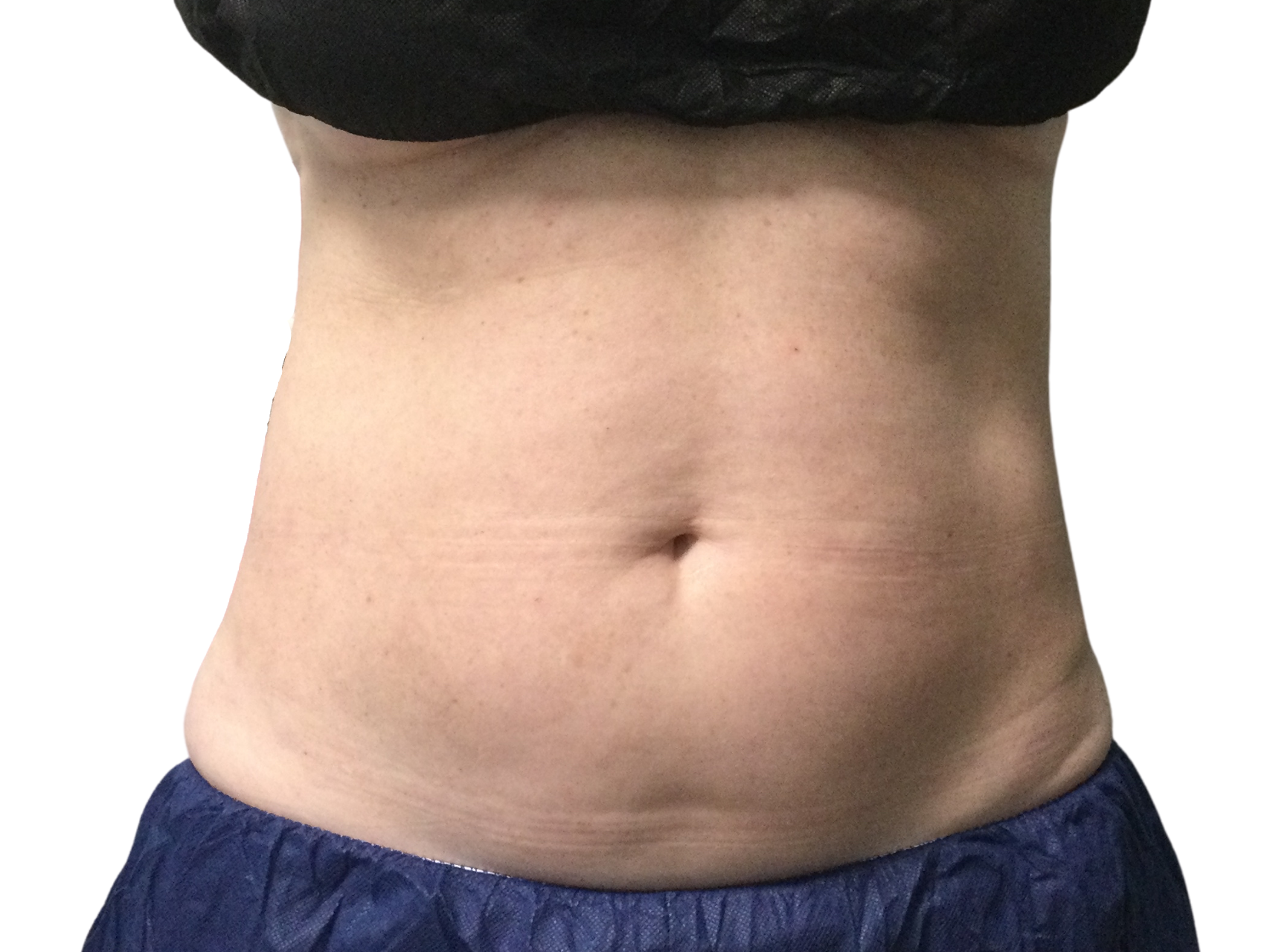 Coolsculpting® Patient Photo - Case 18571 - before view-