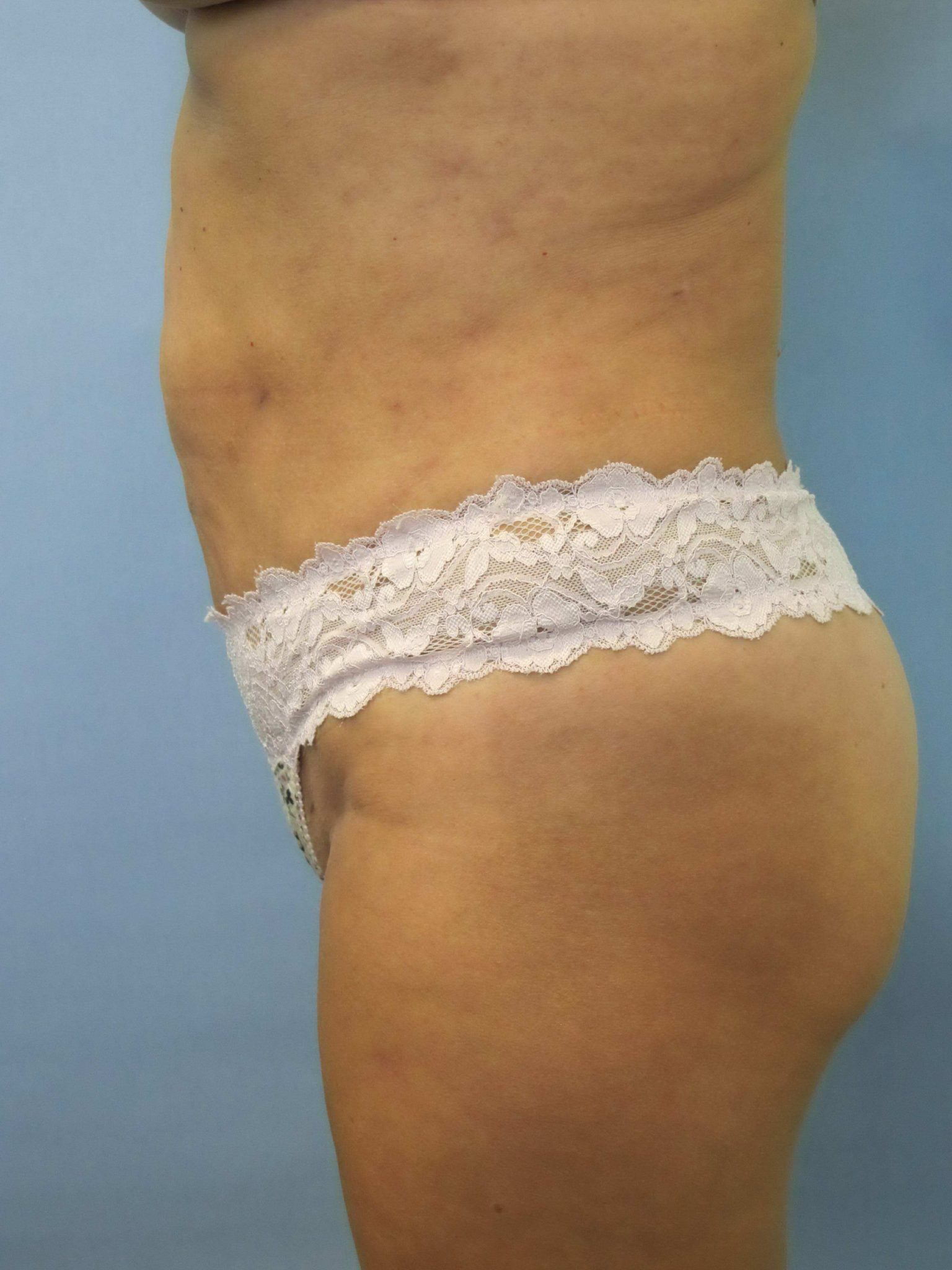 Liposuction Patient Photo - Case 80 - after view