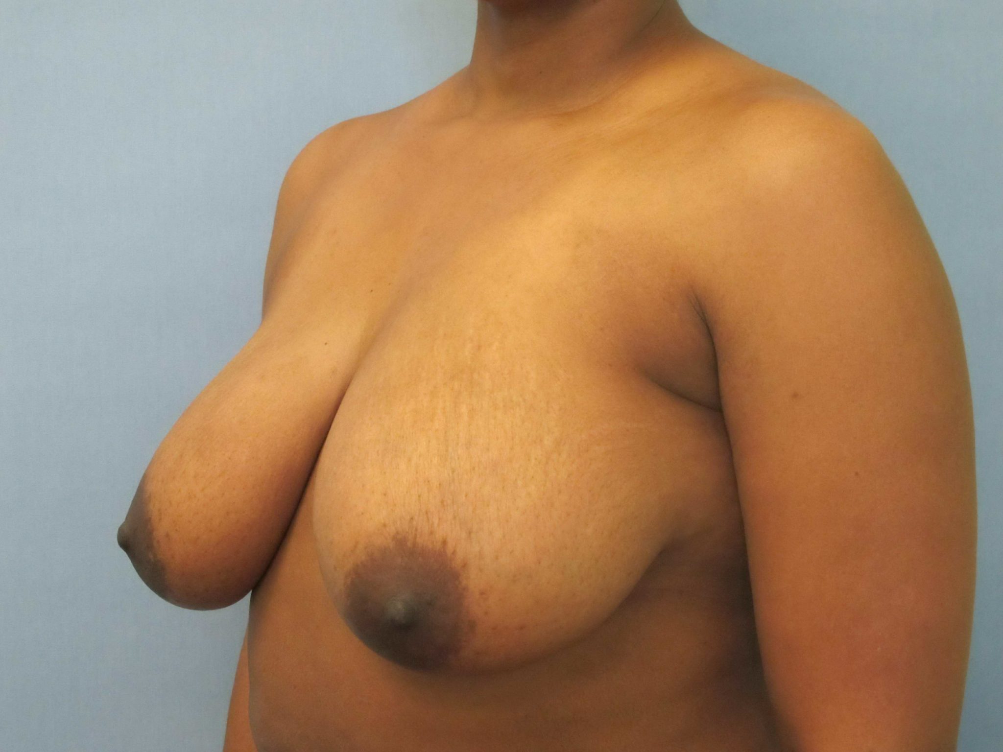 Breast Reduction Patient Photo - Case 141 - before view-1
