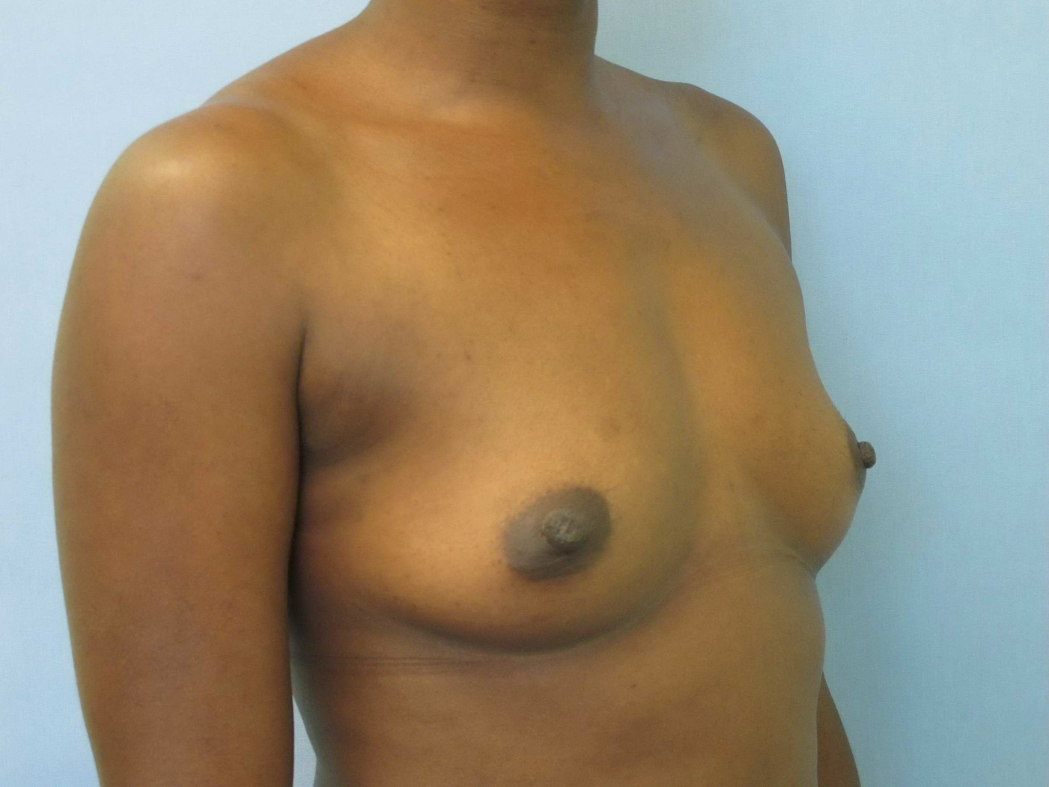 Breast Augmentation Patient Photo - Case 152 - before view-1