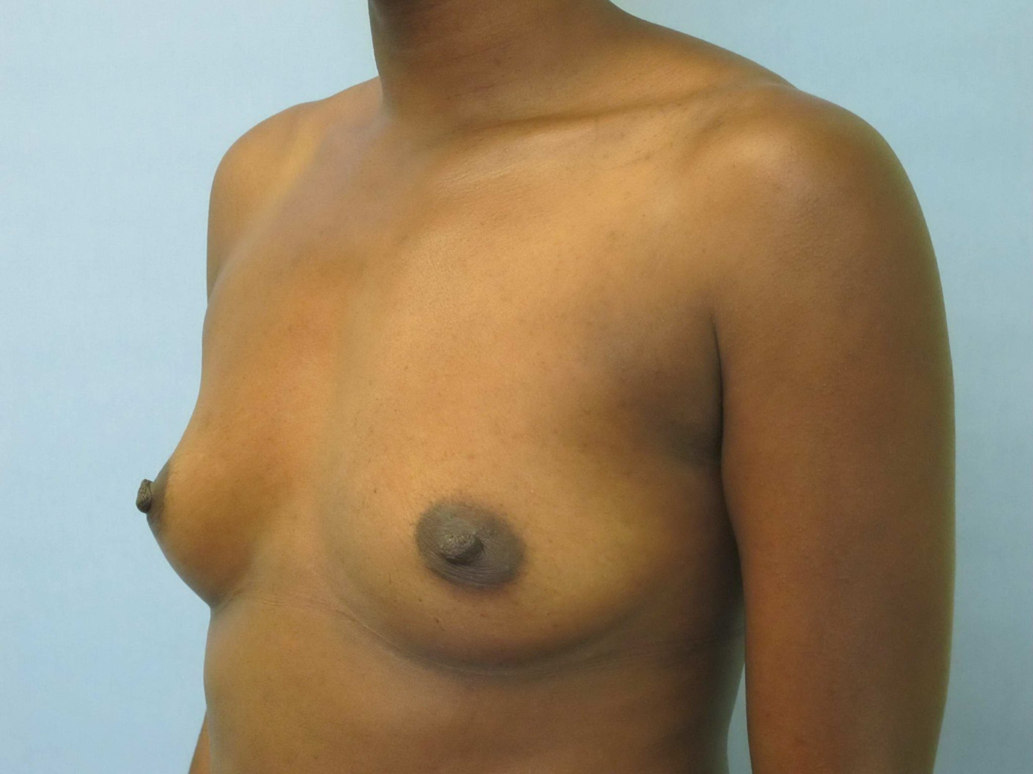 Breast Augmentation Patient Photo - Case 152 - before view-0