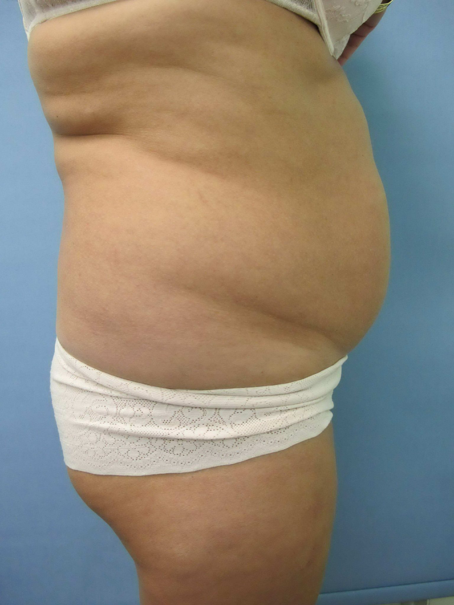 Liposuction Patient Photo - Case 80 - before view-1