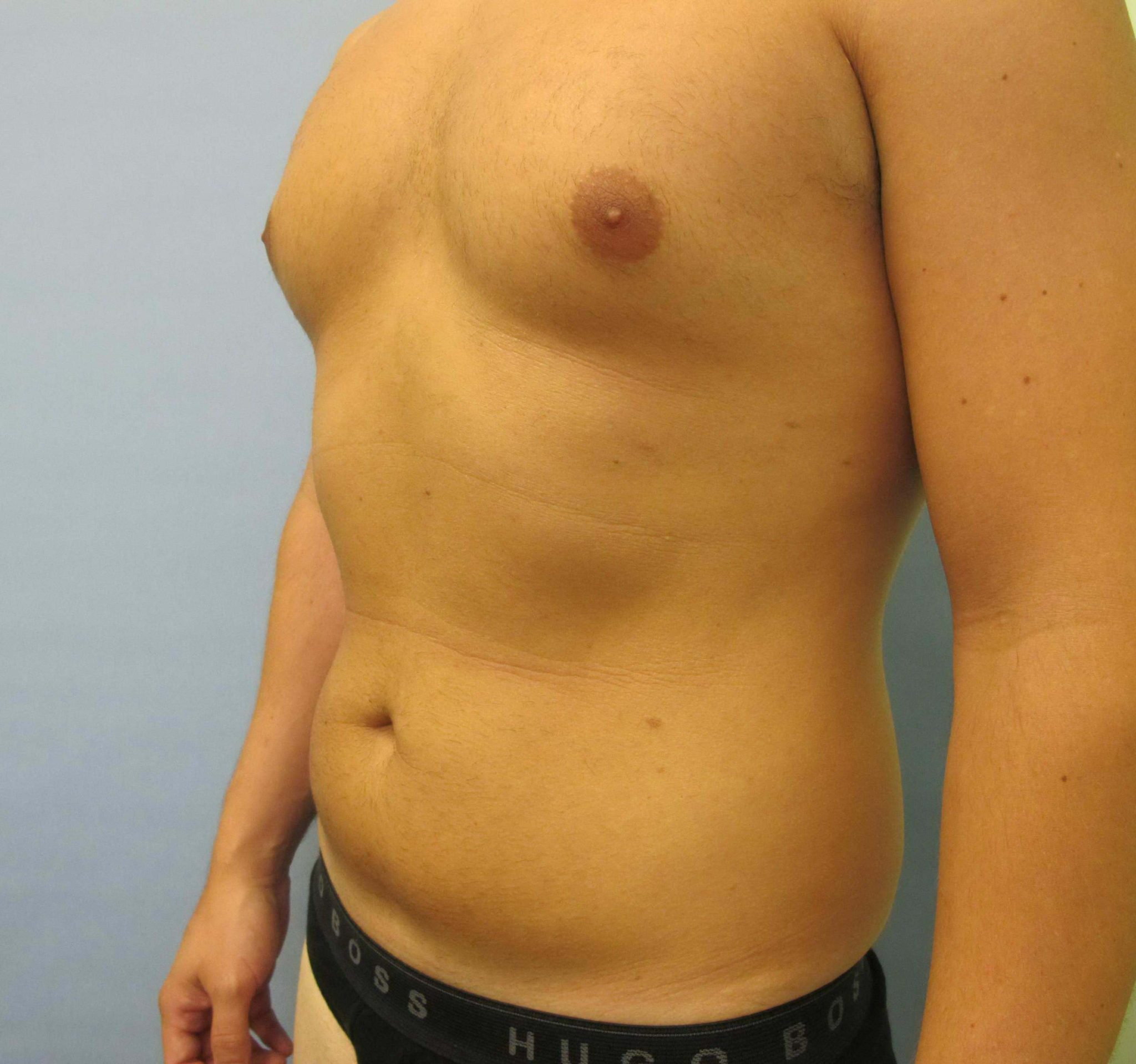 Liposuction Patient Photo - Case 118 - before view-1