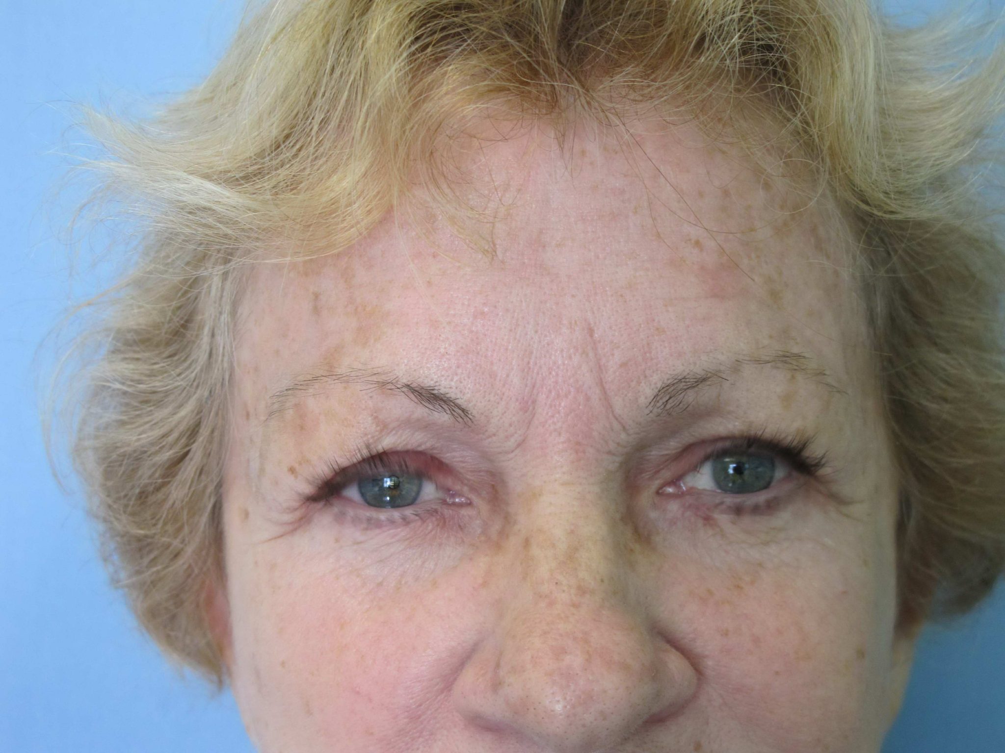 Eyelid Surgery Patient Photo - Case 124 - before view-