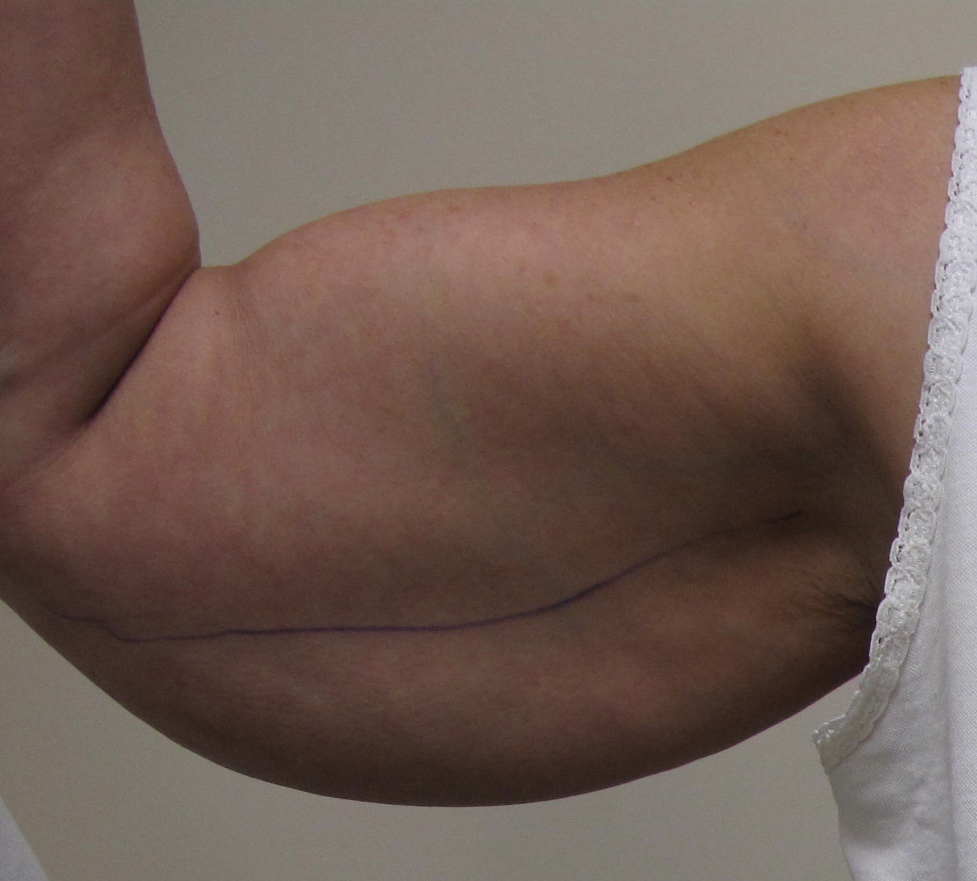 Arm Lift Patient Photo - Case 114 - before view-3