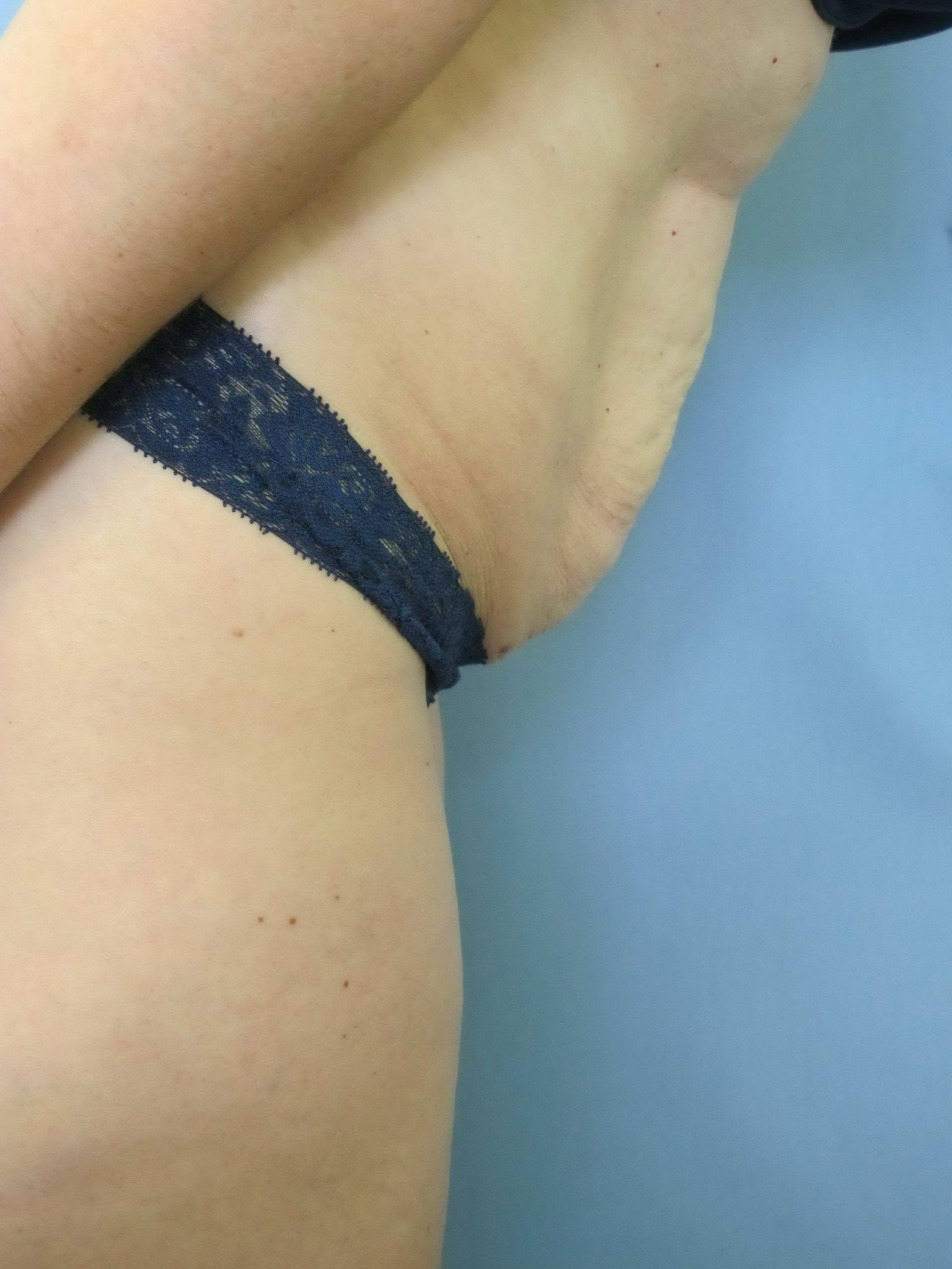 Avelar Tummy Tuck Patient Photo - Case 115 - before view-1
