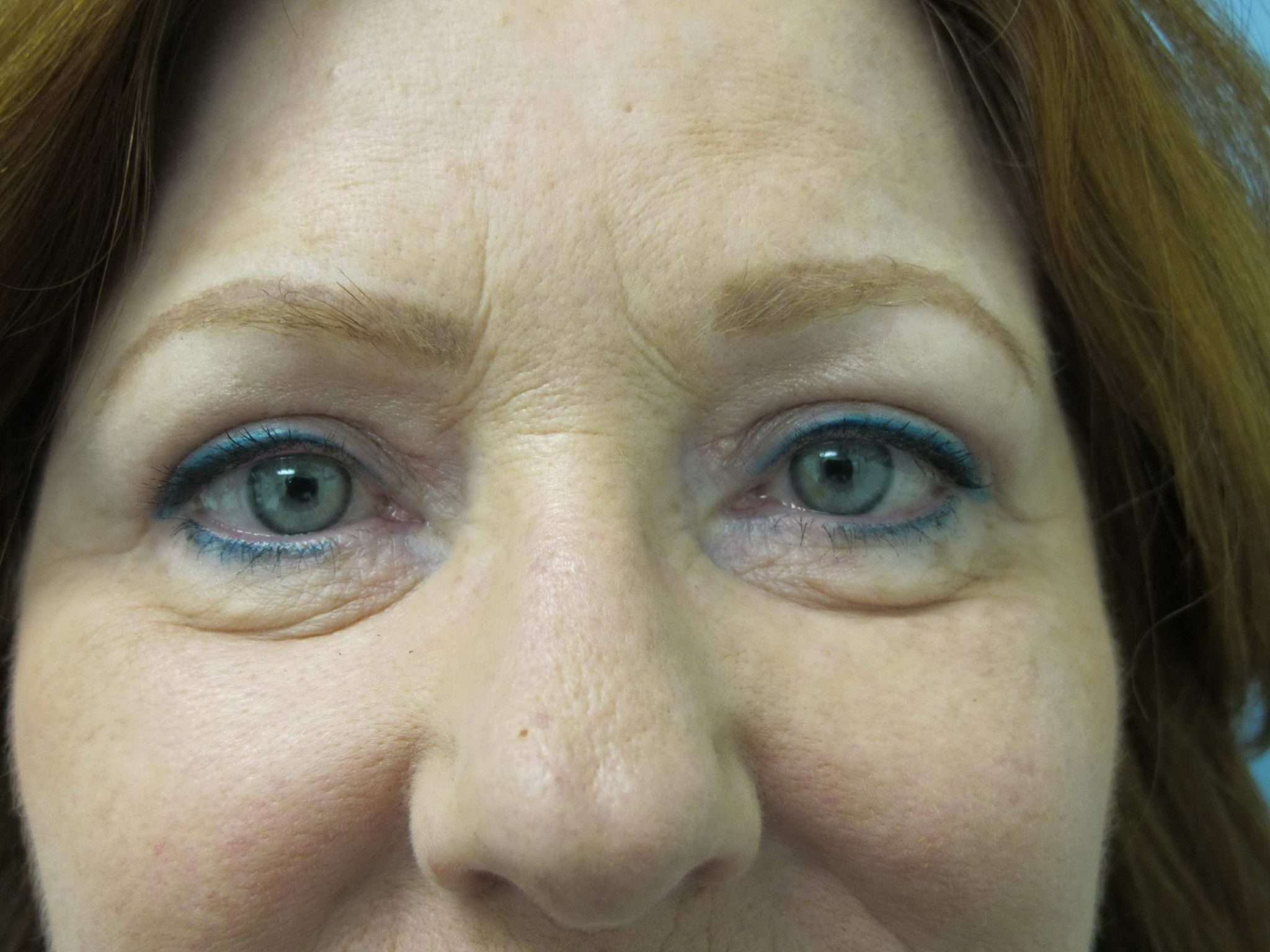 Eyelid Surgery Patient Photo - Case 116 - after view-1