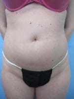 Liposuction - Case 81 - Before