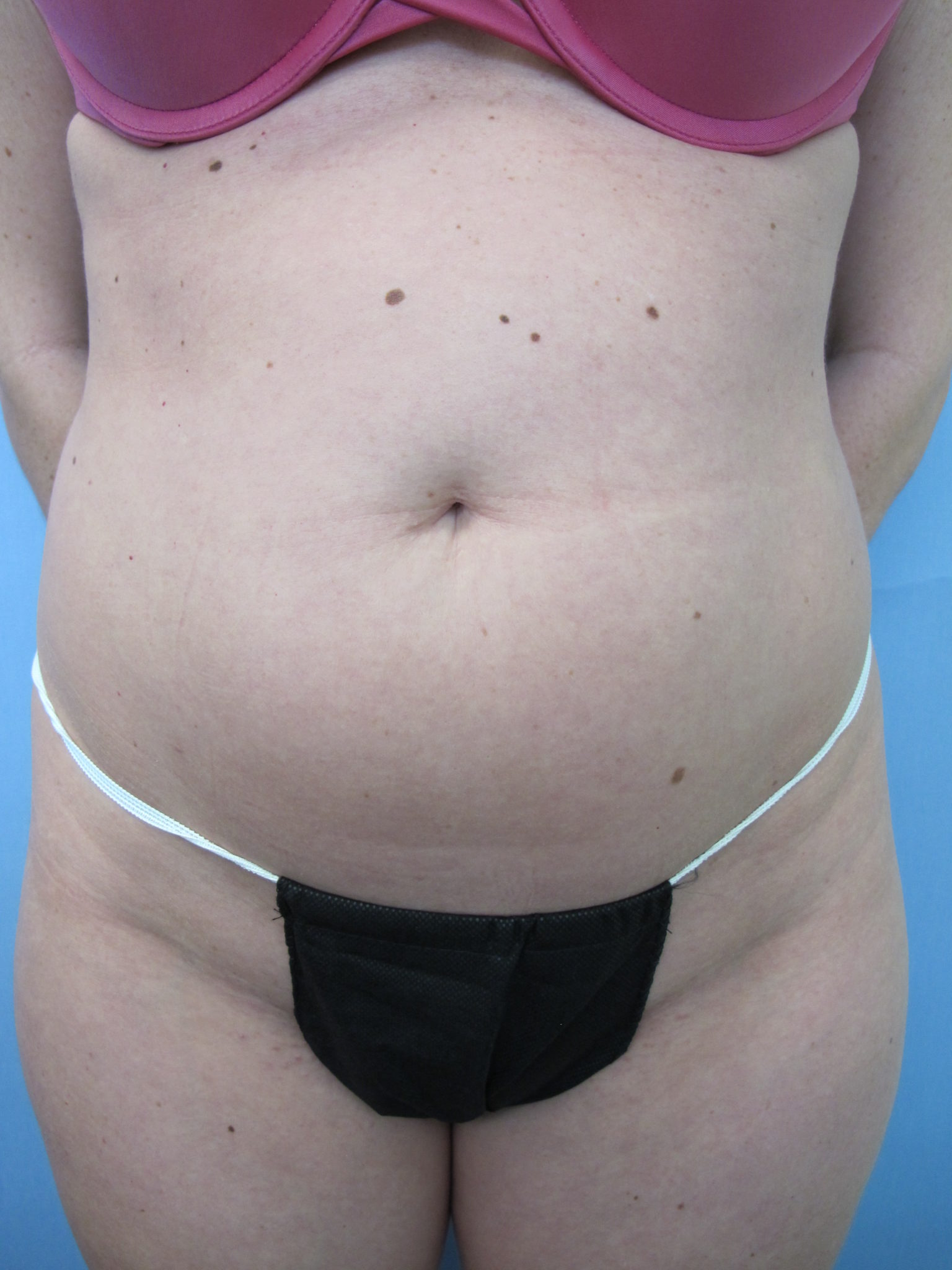 Liposuction Patient Photo - Case 81 - before view-0