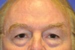 Eyelid Surgery - Case 108 - Before