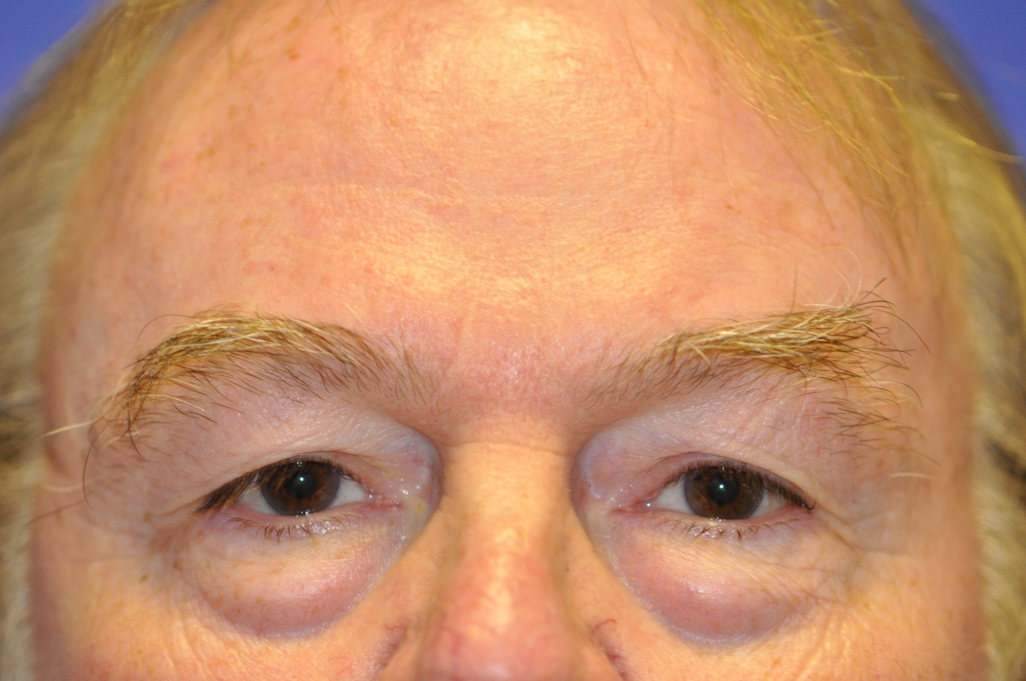 Eyelid Surgery Patient Photo - Case 108 - before view-