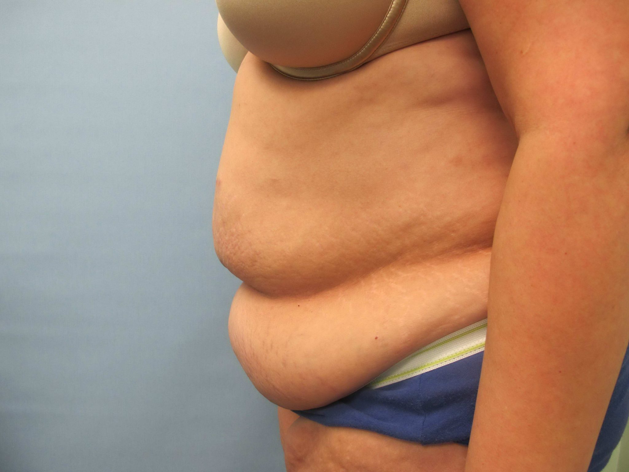 Avelar Tummy Tuck Patient Photo - Case 127 - before view-1