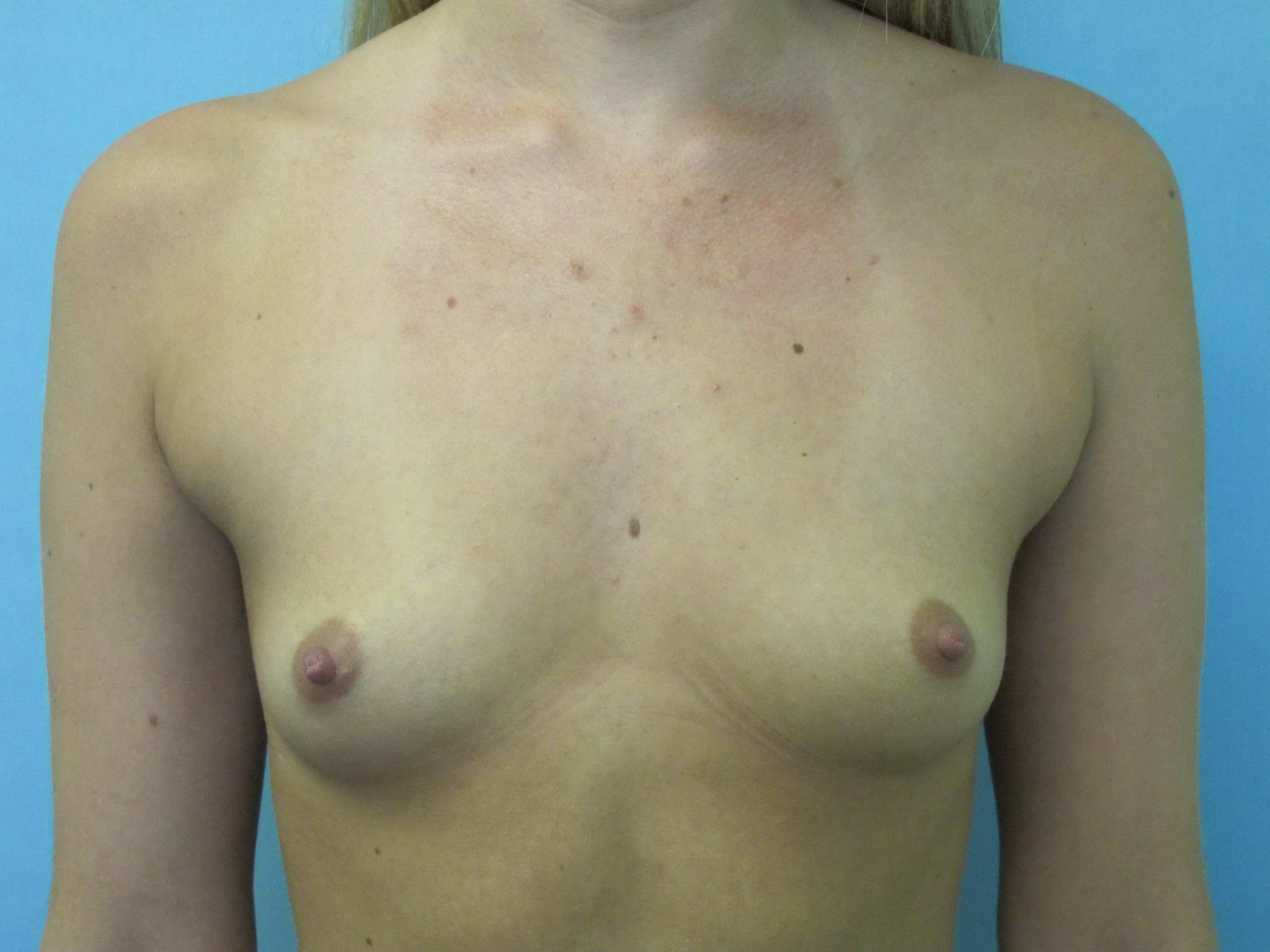 Breast Augmentation Patient Photo - Case 41 - before view-0
