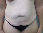 Liposuction - Case 75 - Before