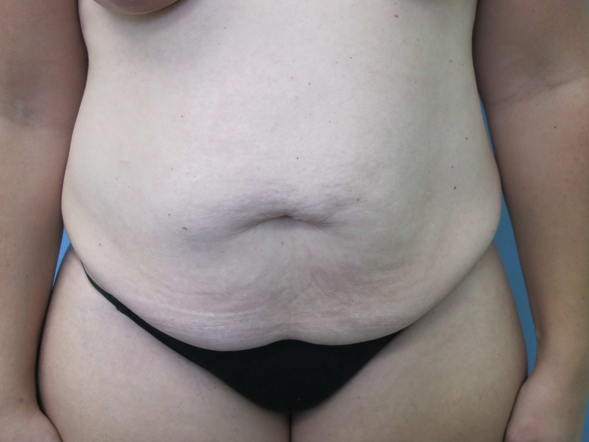 Liposuction Patient Photo - Case 75 - before view-0