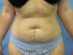 Liposuction - Case 84 - Before
