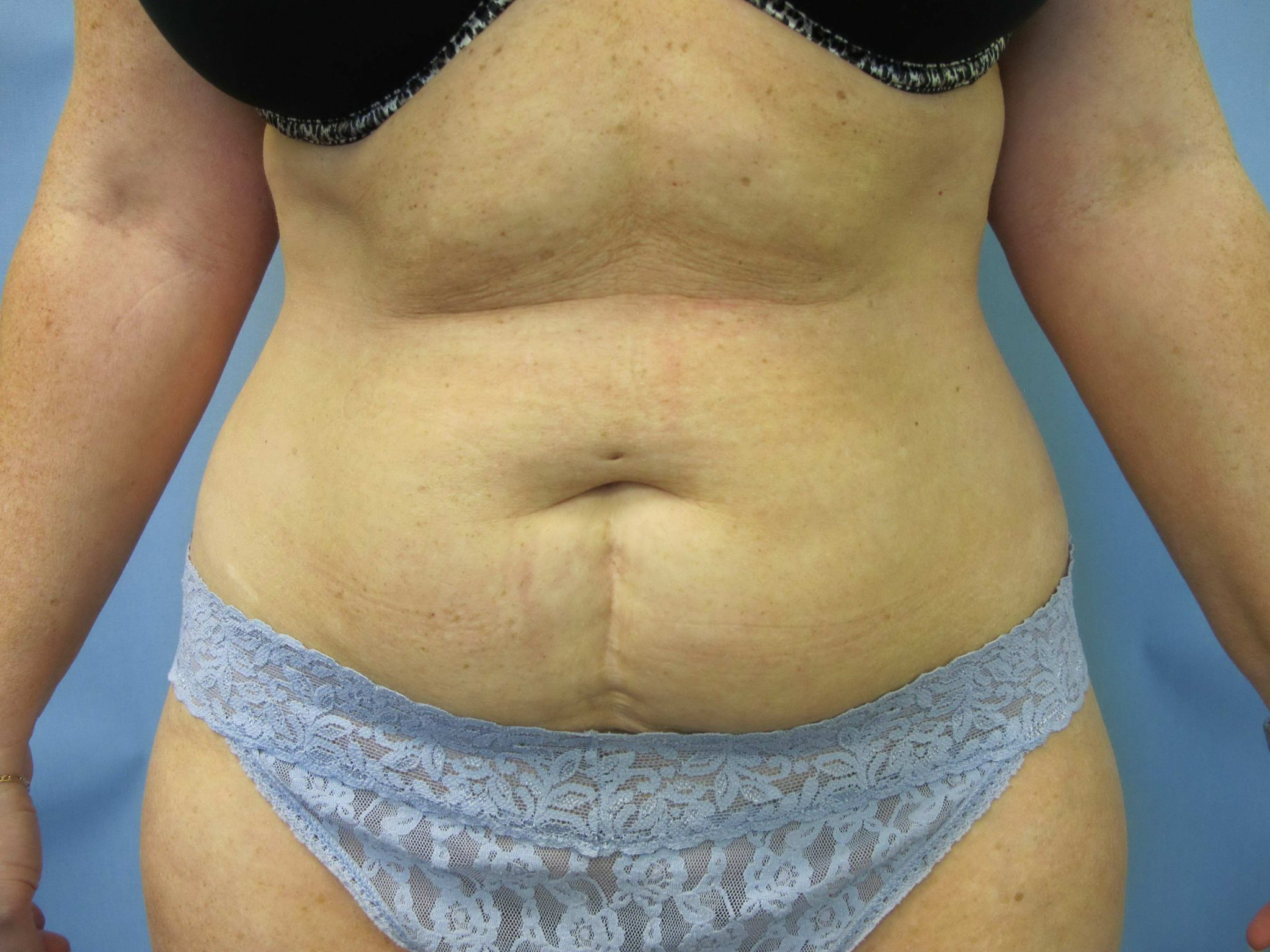 Liposuction Patient Photo - Case 84 - before view-0