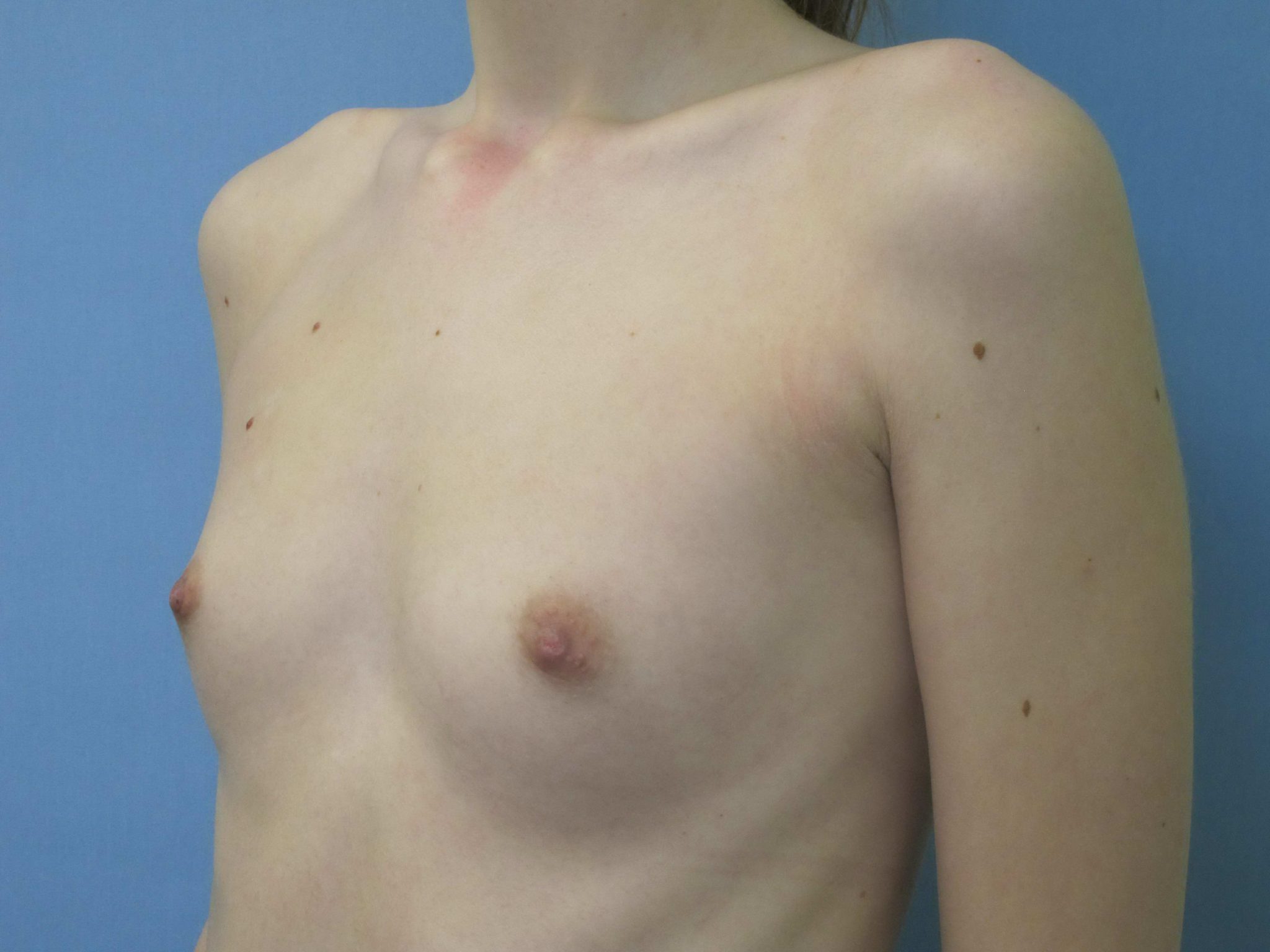 Breast Augmentation Patient Photo - Case 131 - before view-1