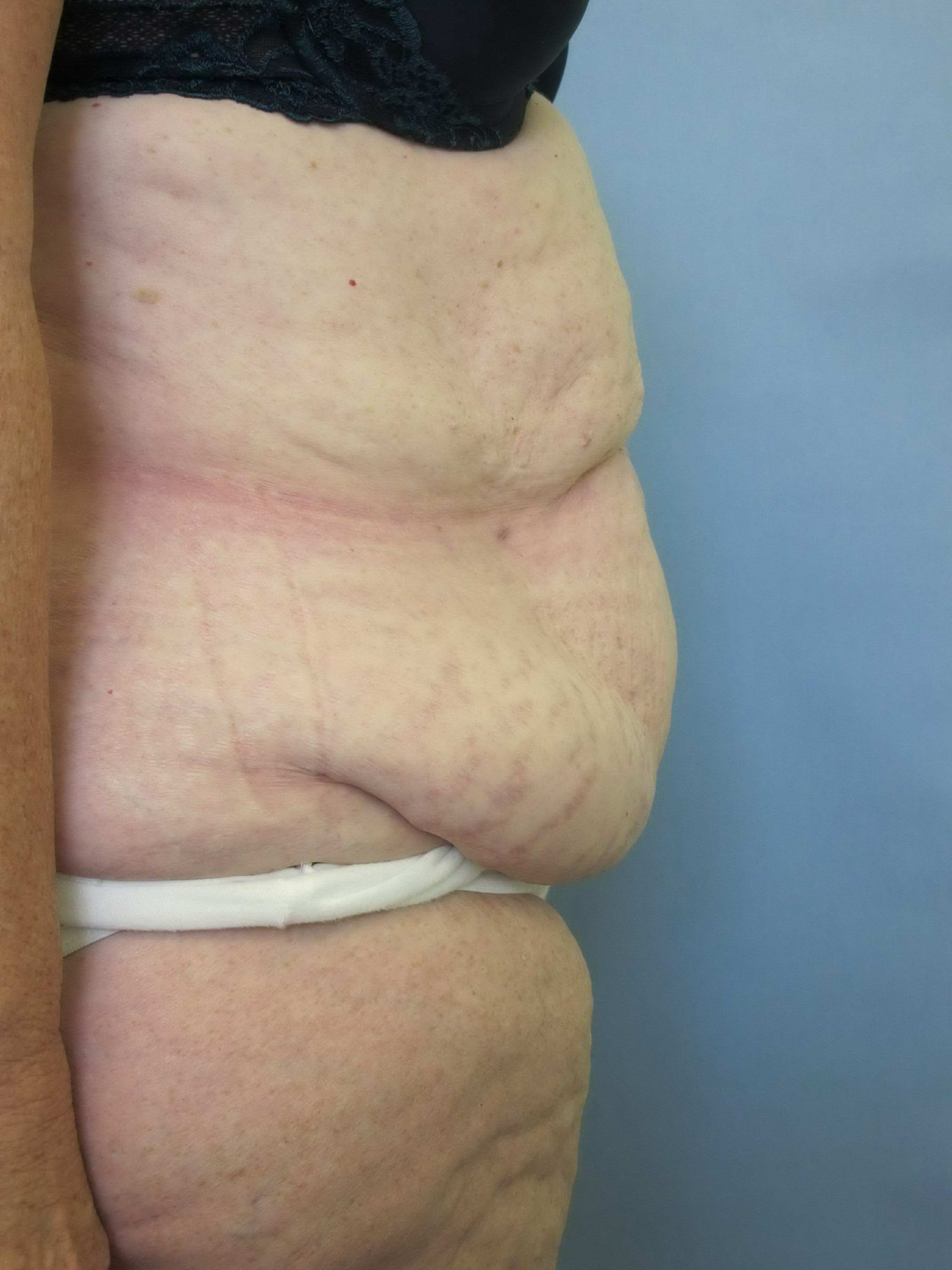 Liposuction Patient Photo - Case 78 - before view-1
