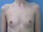Breast Augmentation - Case 131 - Before