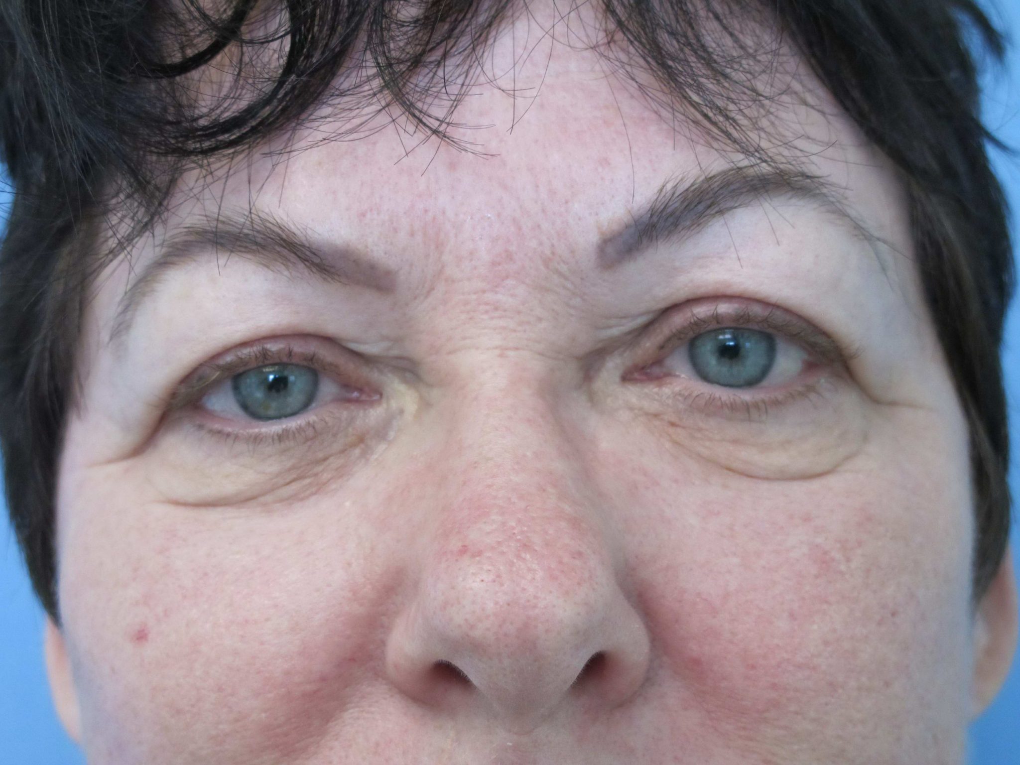 Eyelid Surgery Patient Photo - Case 121 - before view-