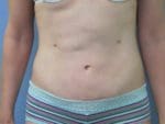 Liposuction - Case 146 - After