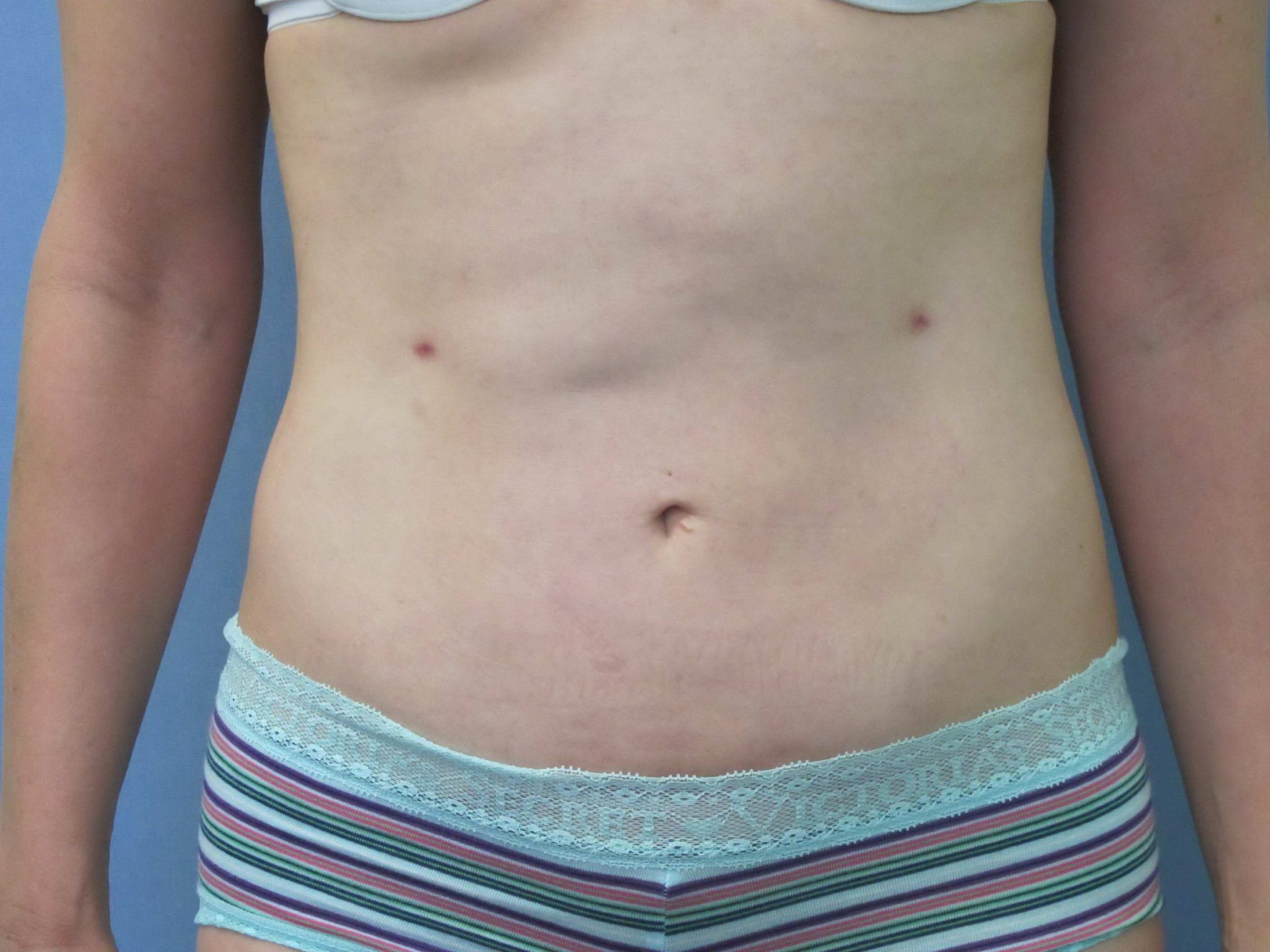 Liposuction Patient Photo - Case 146 - after view-0
