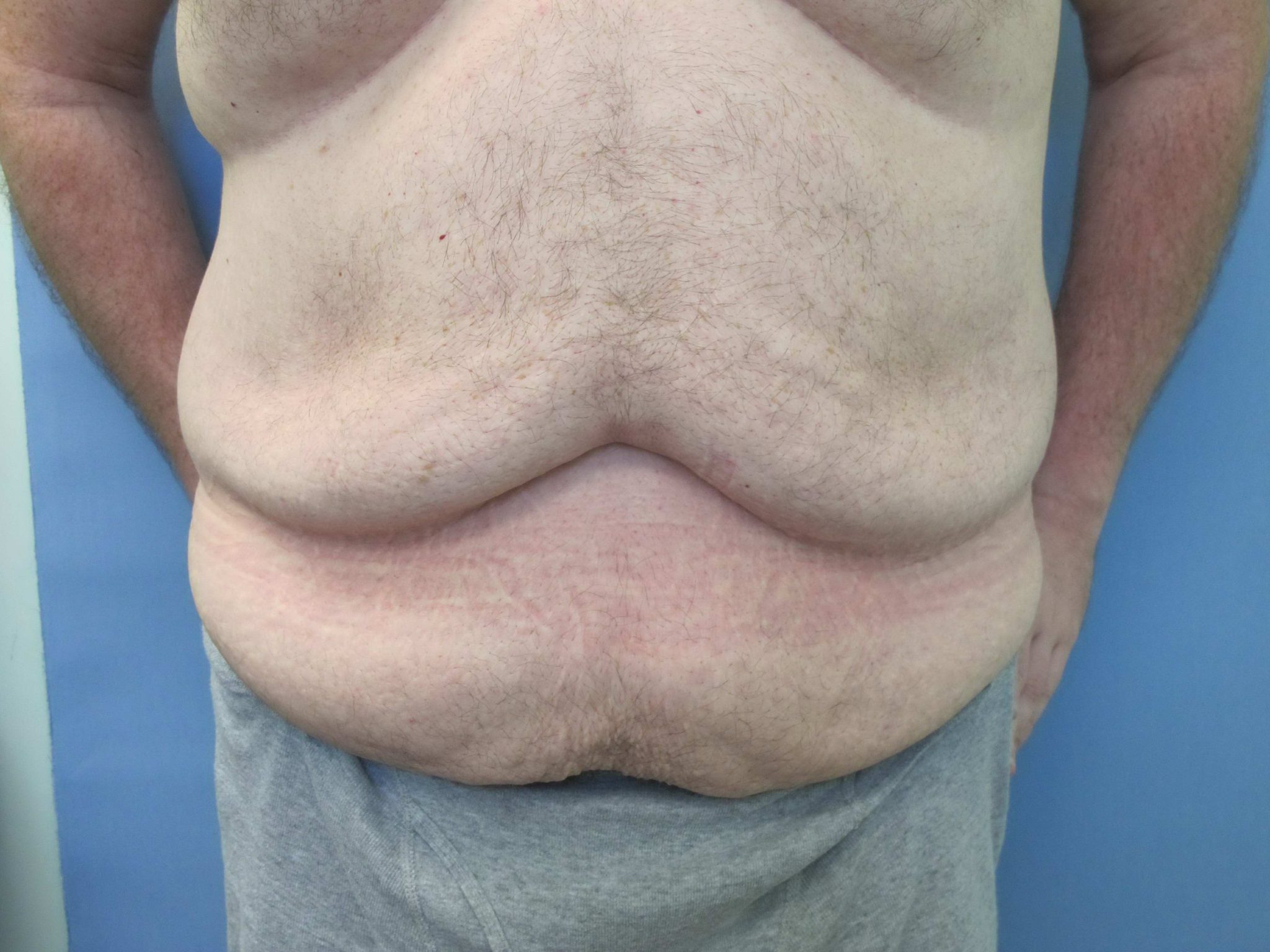 Liposuction Patient Photo - Case 76 - before view-0