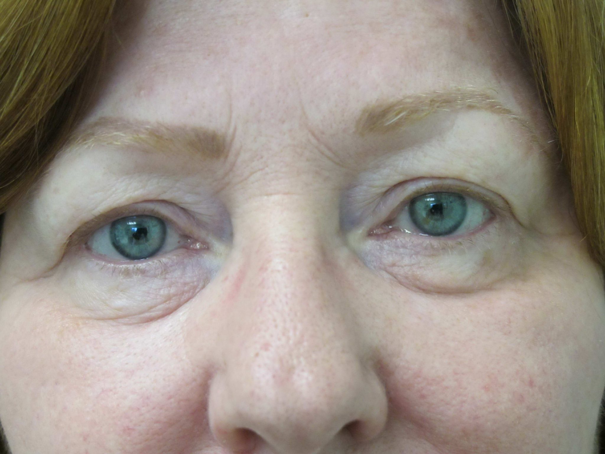 Eyelid Surgery Patient Photo - Case 116 - before view-1